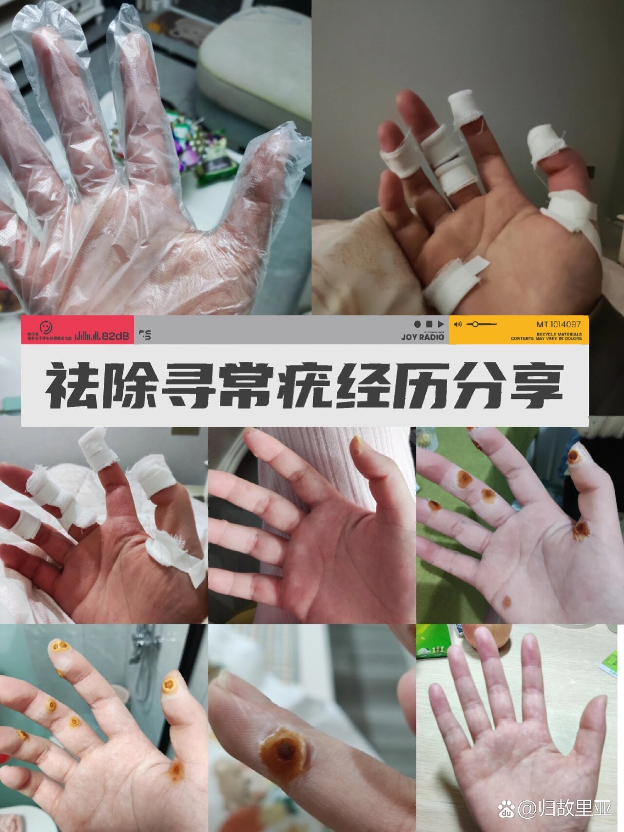 长达五年手上寻常疣祛除过程,纯分享