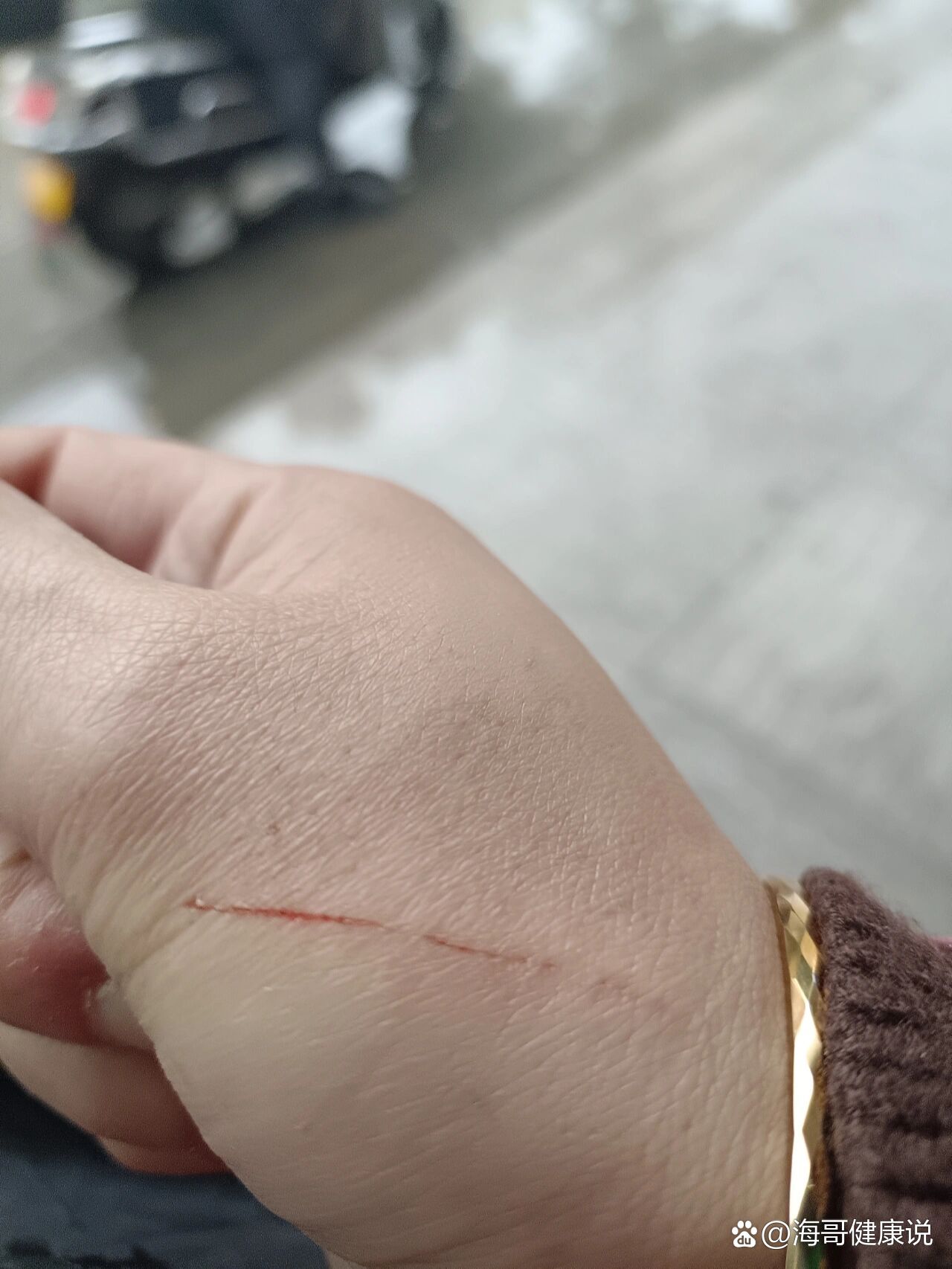 被铁丝划伤了要打破伤风吗