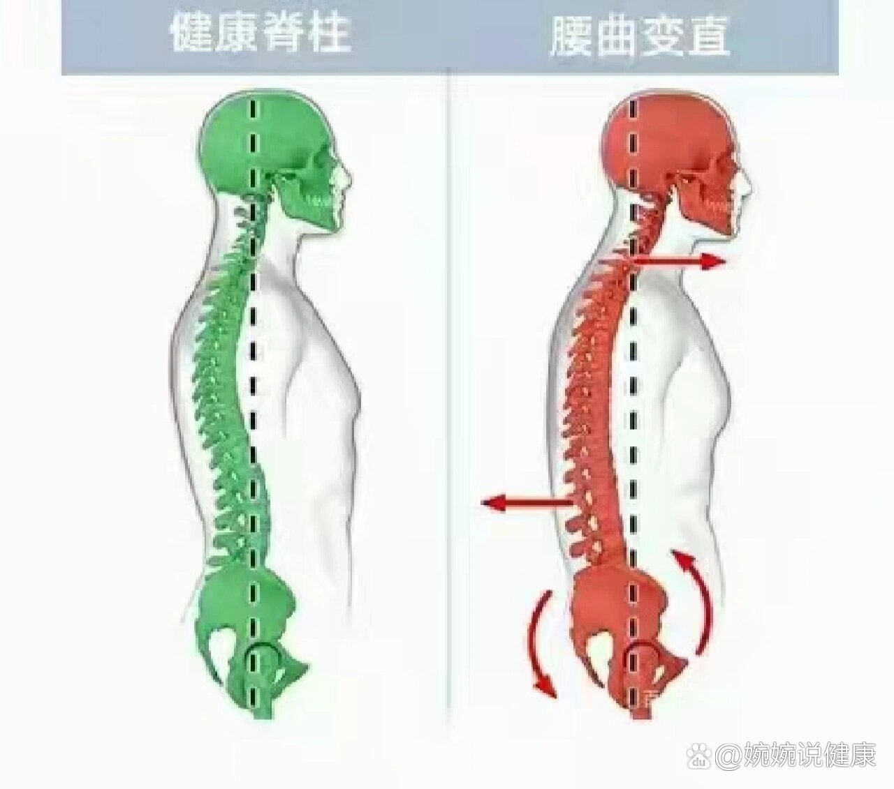 正常人腰椎的弧度图片图片