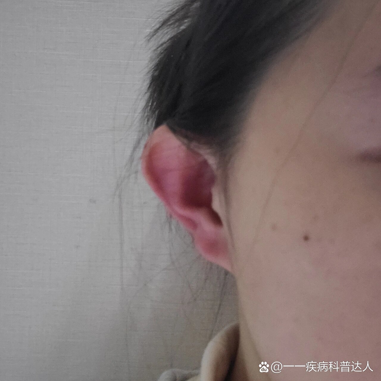 一到晚上耳朵发烫是什么毛病