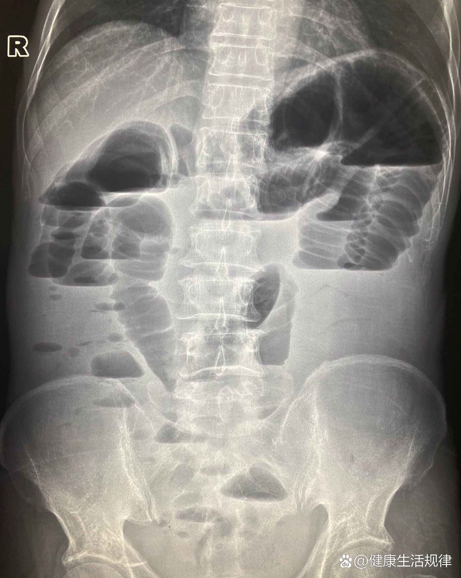 肠梗阻x线报告图片