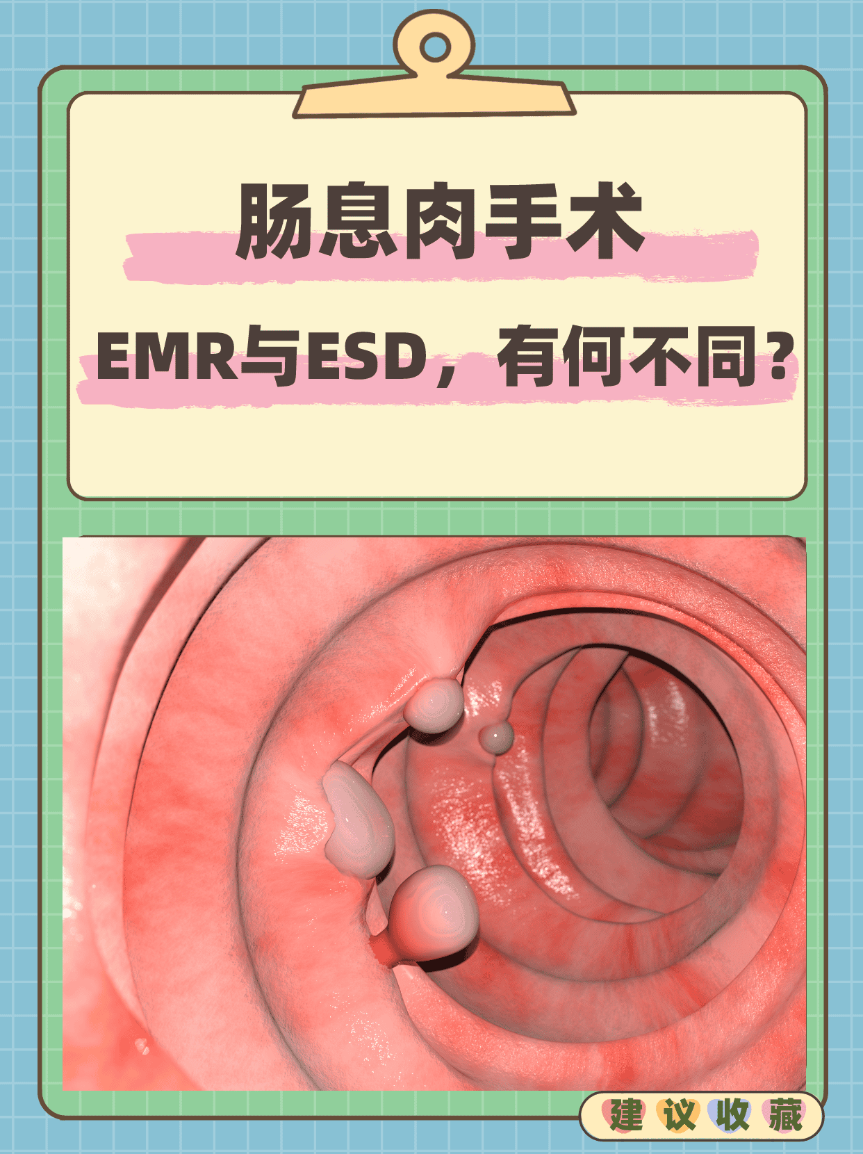 肠息肉手术:emr与esd,有何不同?