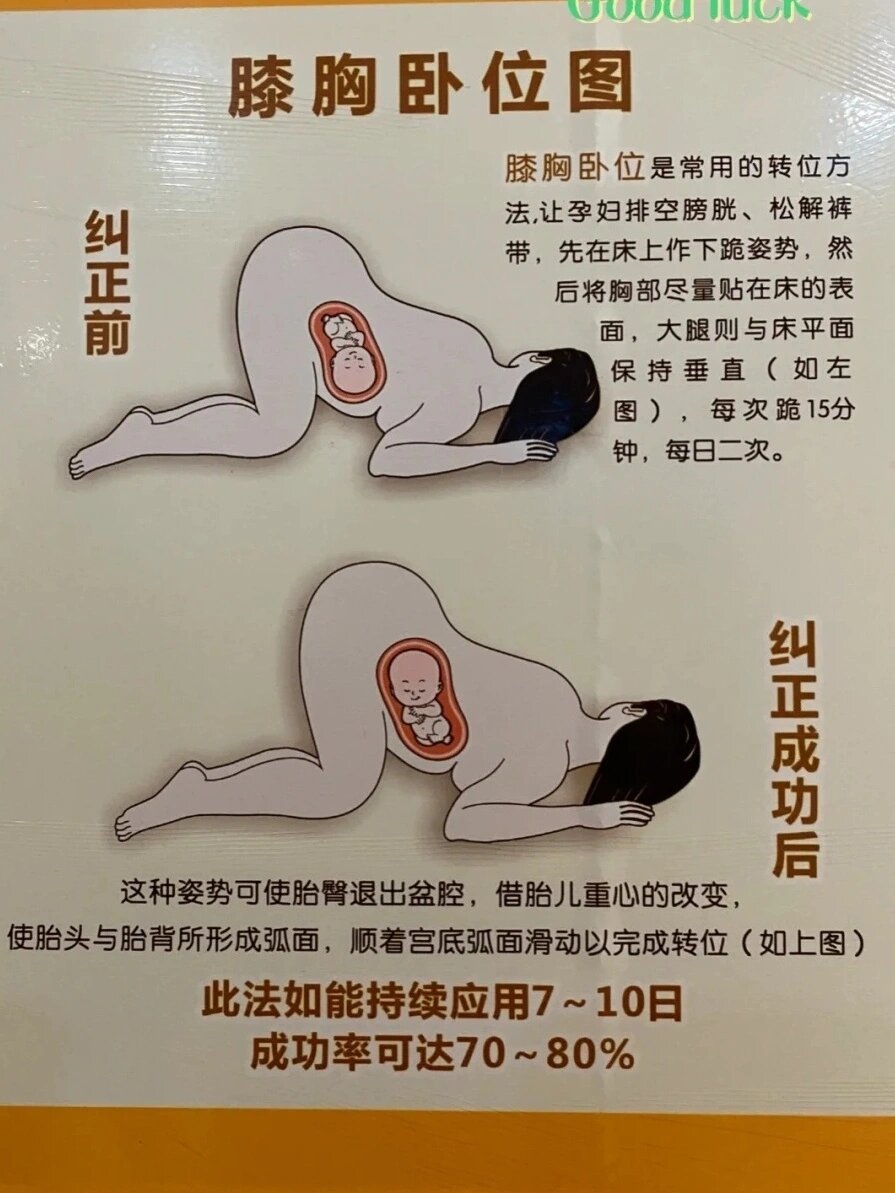 足月后b超显示臀位,还能不能转过来?