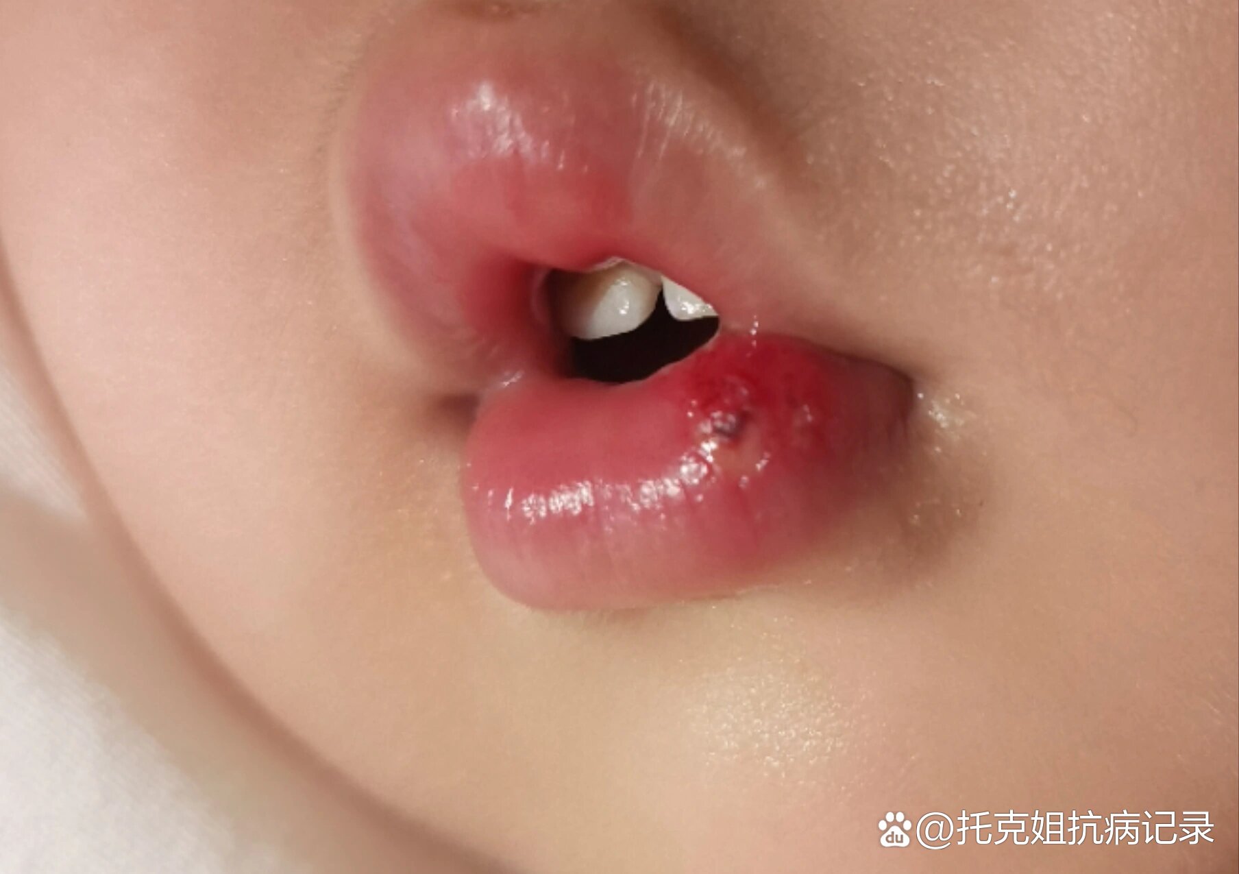 宝宝嘴唇磕破了