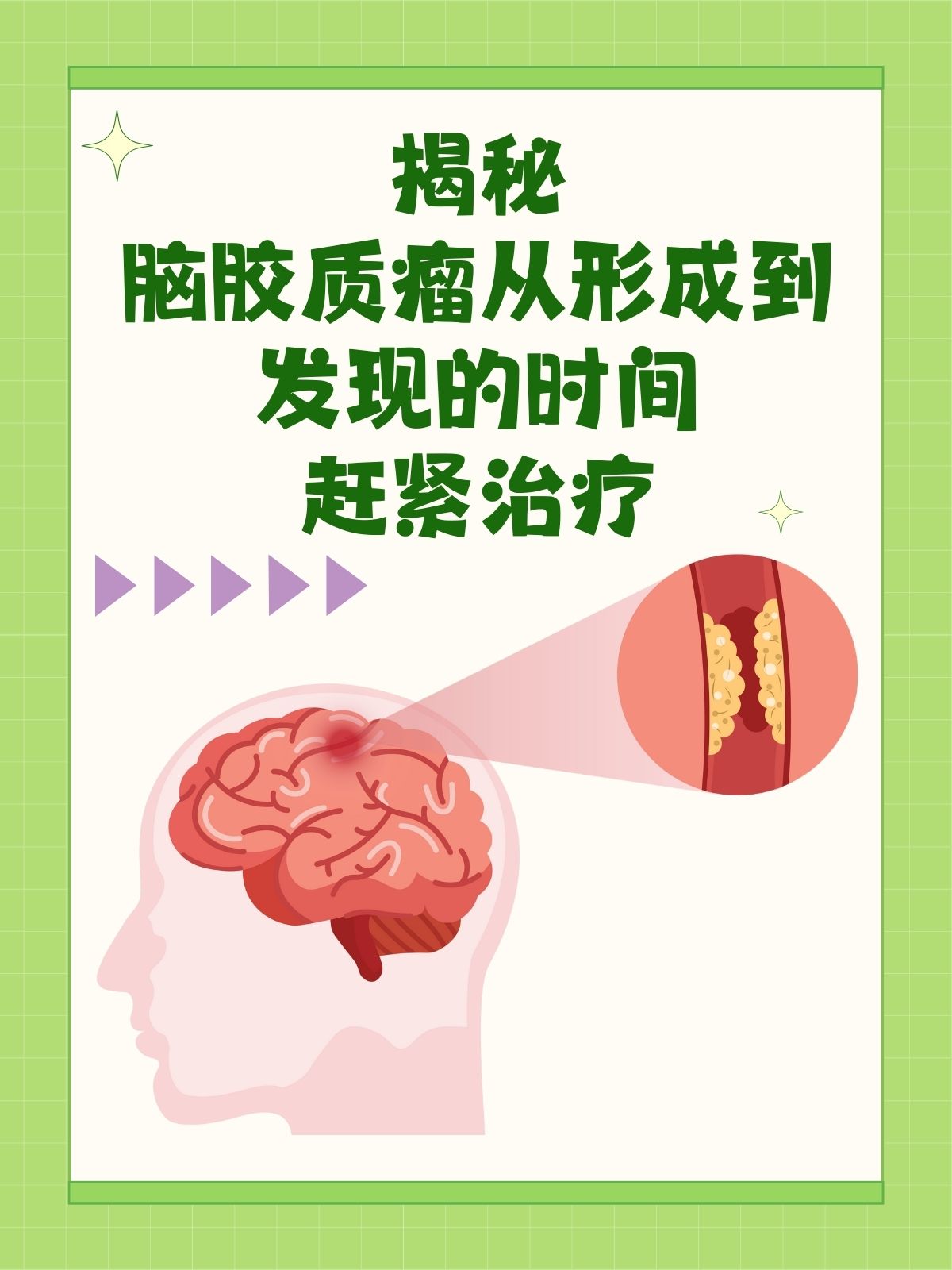 揭秘:脑胶质瘤从形成到发现的时间,赶紧治疗