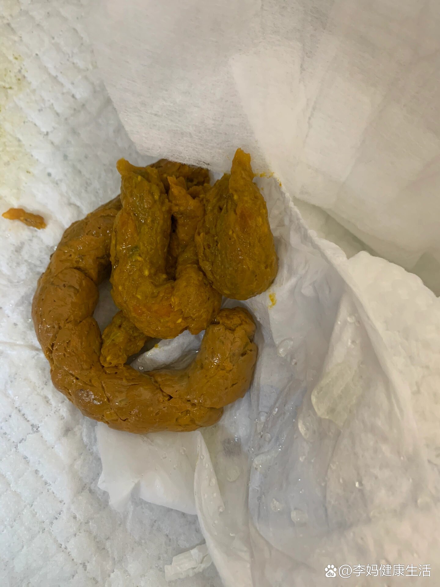 宝宝大便里有白色芝麻粒的东西