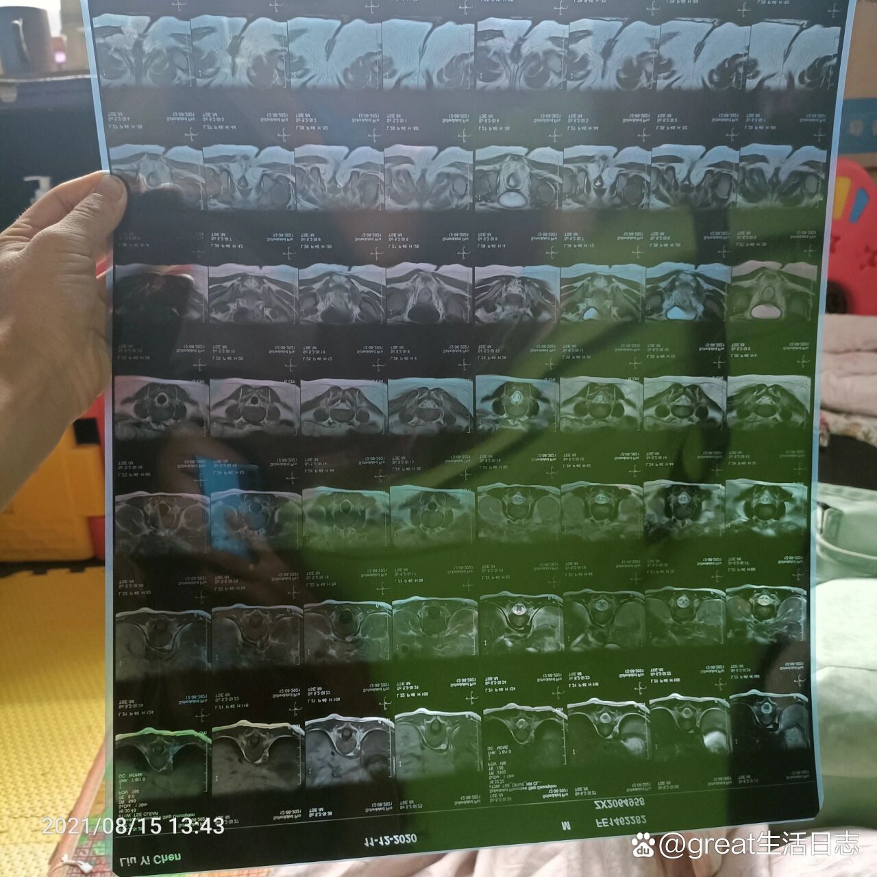 确诊为脊髓栓系终丝增粗