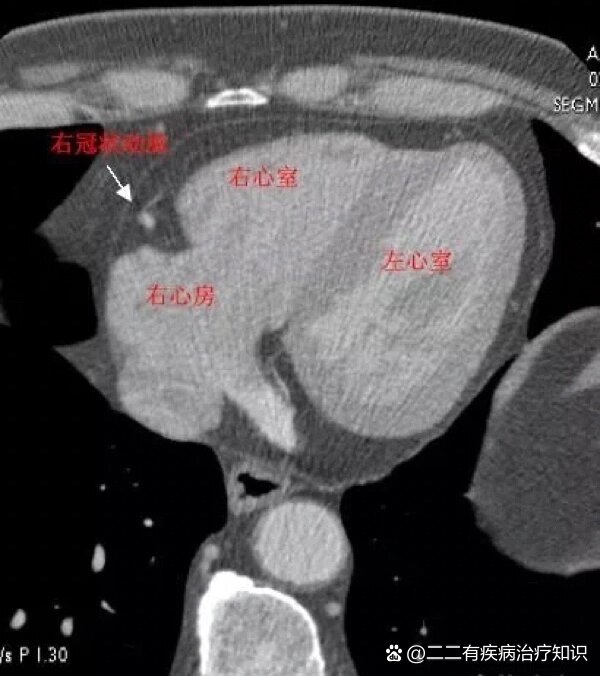 02心脏ct解剖图