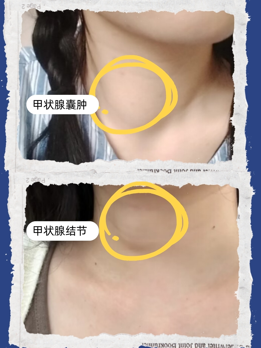 知己知彼,分清甲状腺囊肿和甲状腺结节!