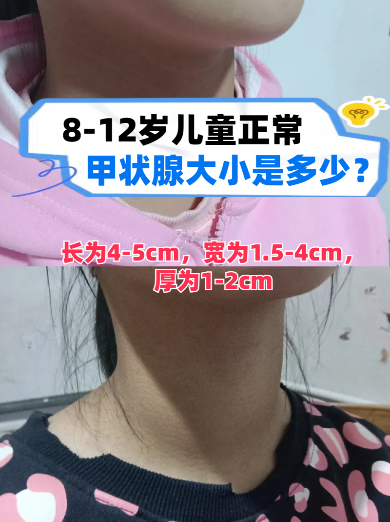 8-12岁儿童正常甲状腺大小是多少?