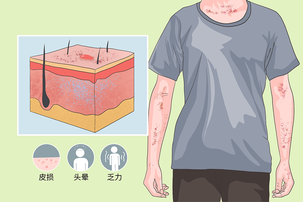 怎样淤青是得了白血病