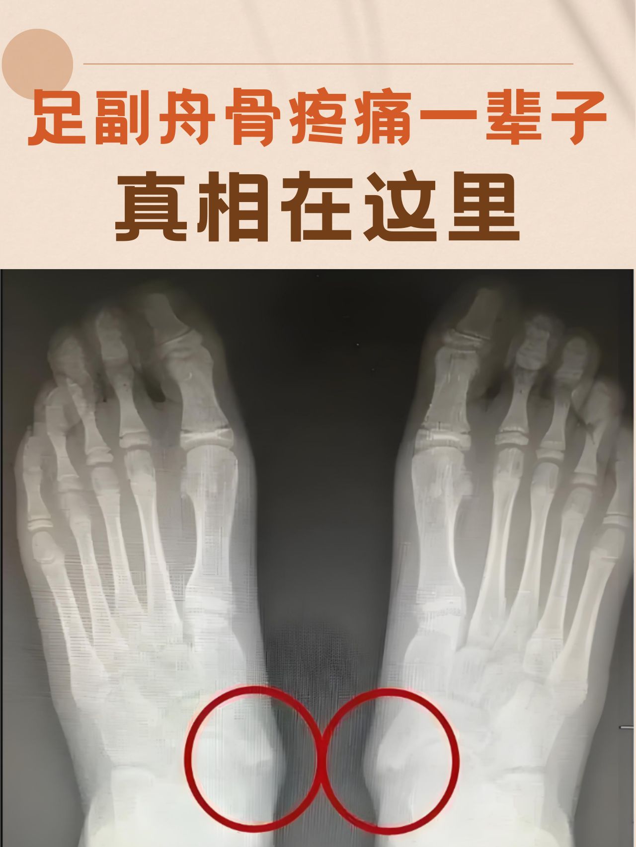 足副舟骨疼痛一辈子?真相在这里