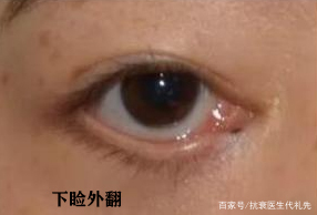 从整形医生的角度说一说:下眼睑外翻怎么办?