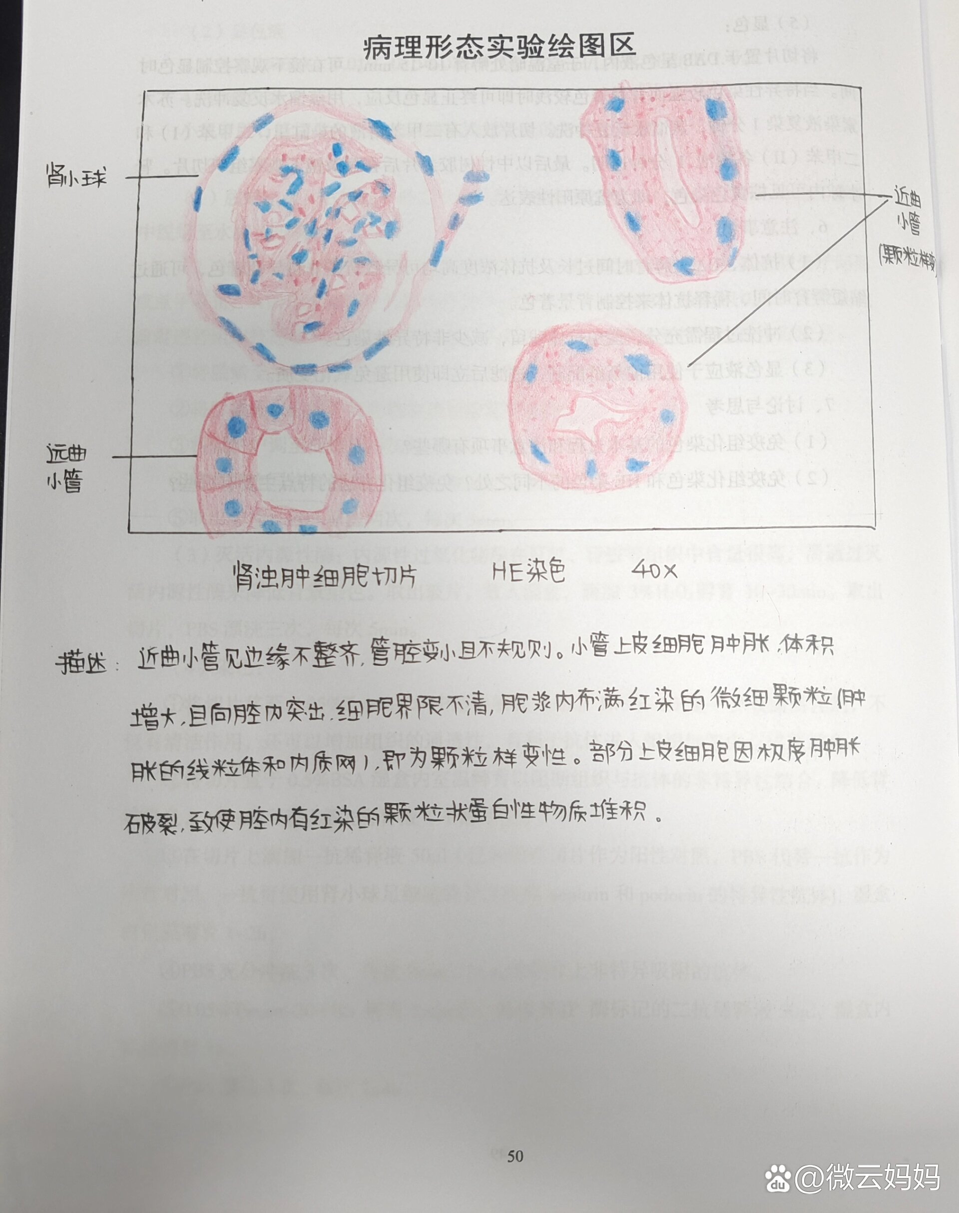 肾脓肿切片绘图图片