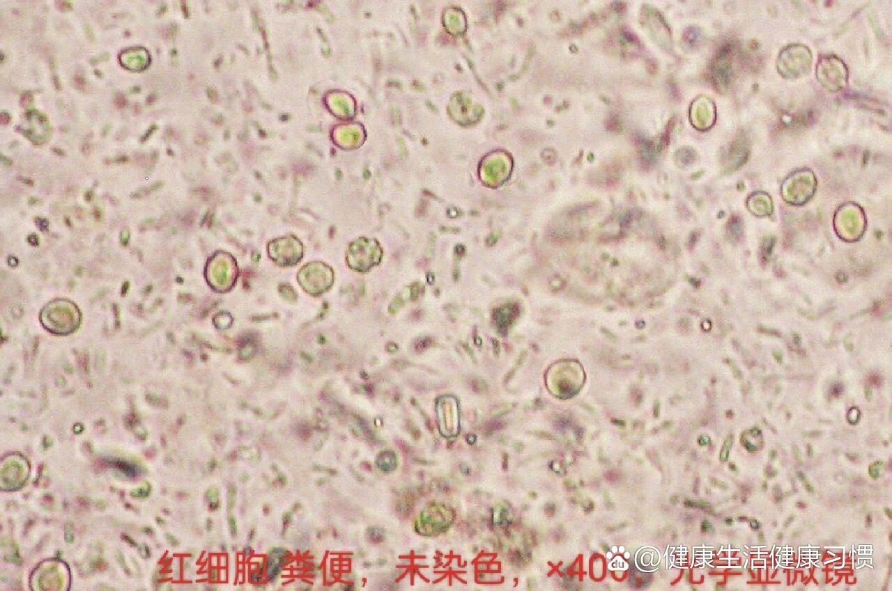 大便镜下细胞图片大全图片