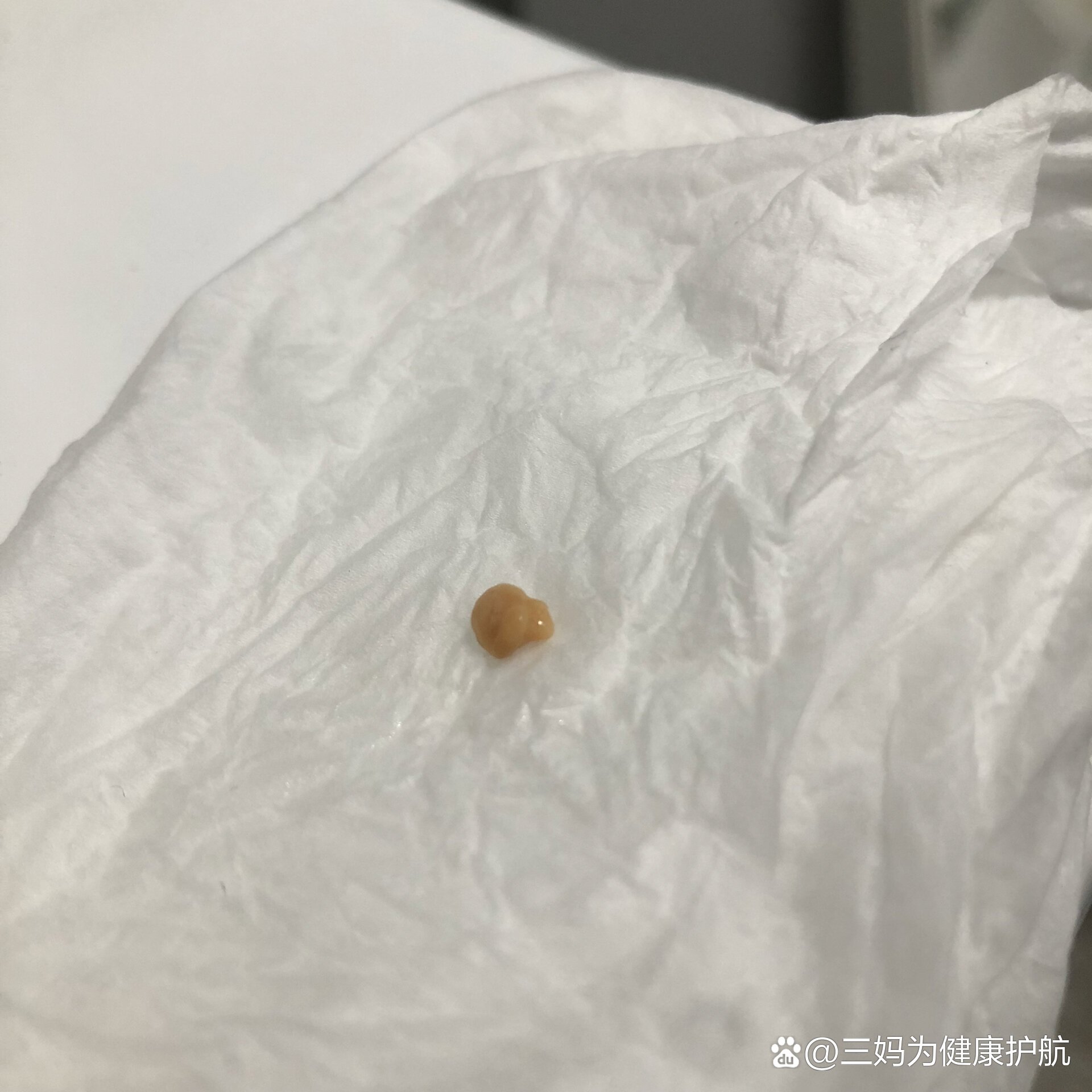 扁桃体隐窝清理棉签图片