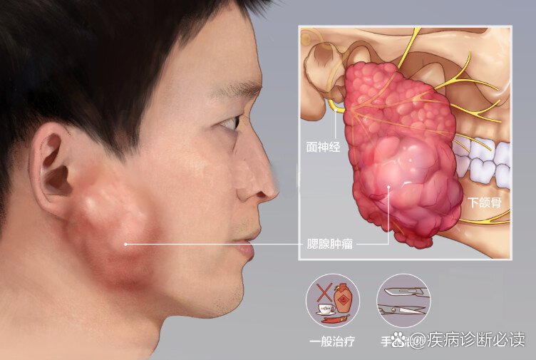 腮腺结节的位置图片图片