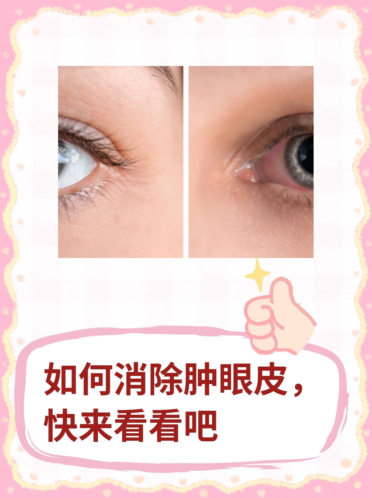 如何消除肿眼皮,快来看看吧
