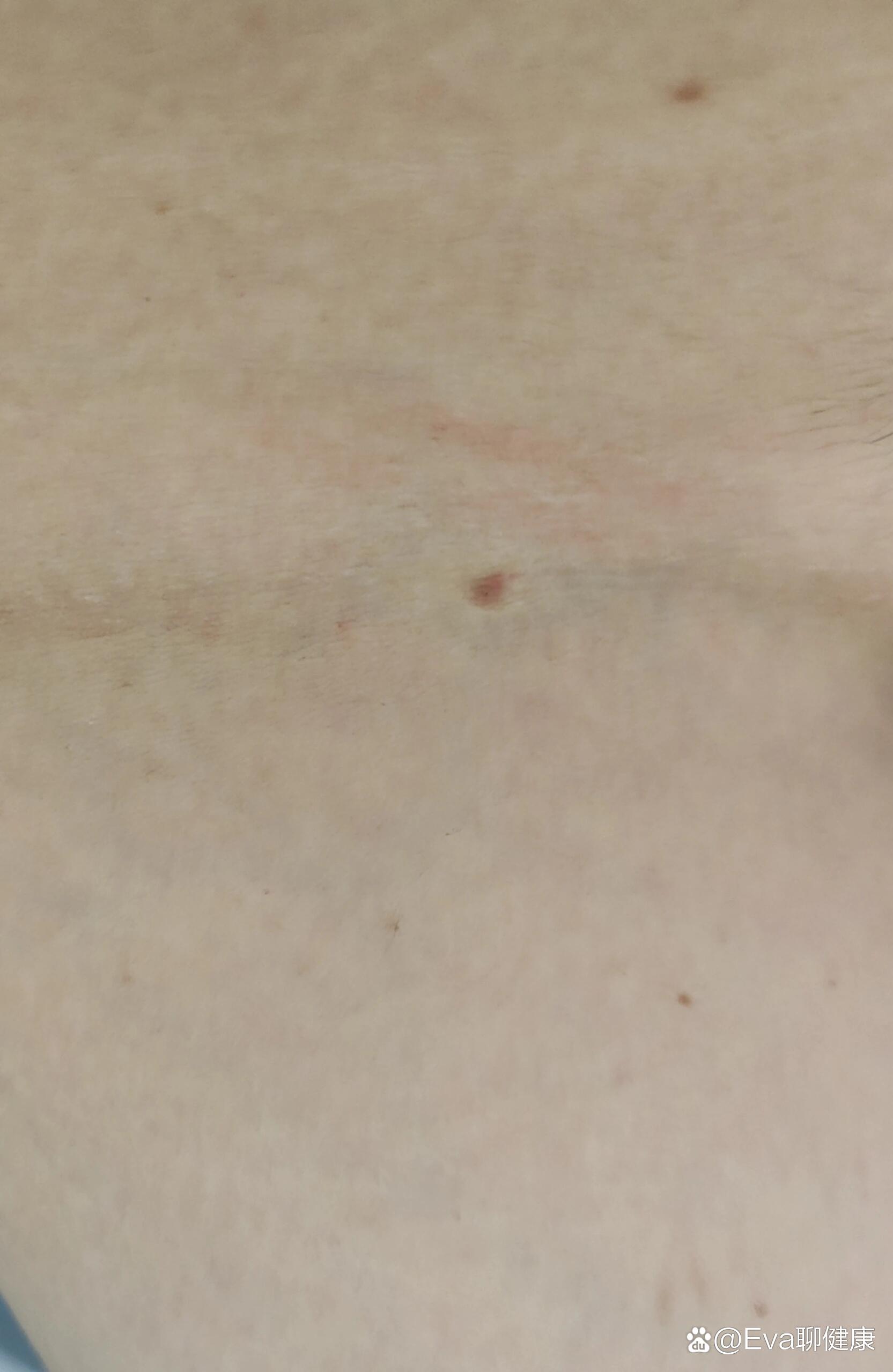 腹股沟起的小红疙瘩,有点痒