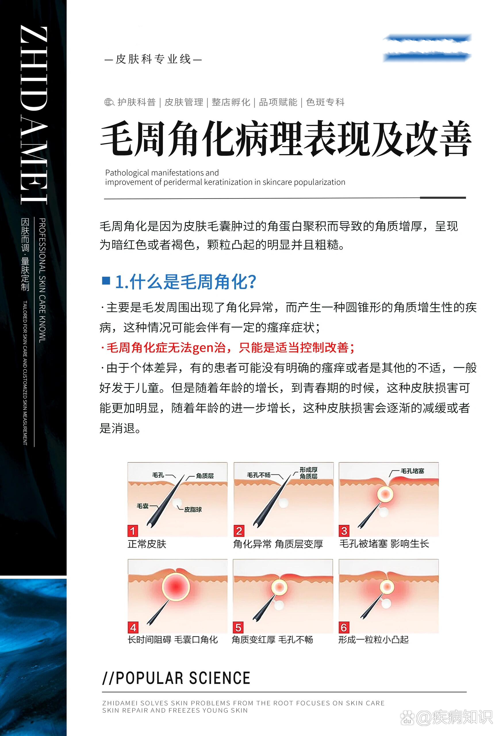 精准护肤‖毛周角化如何改善毛周角化不能根治?