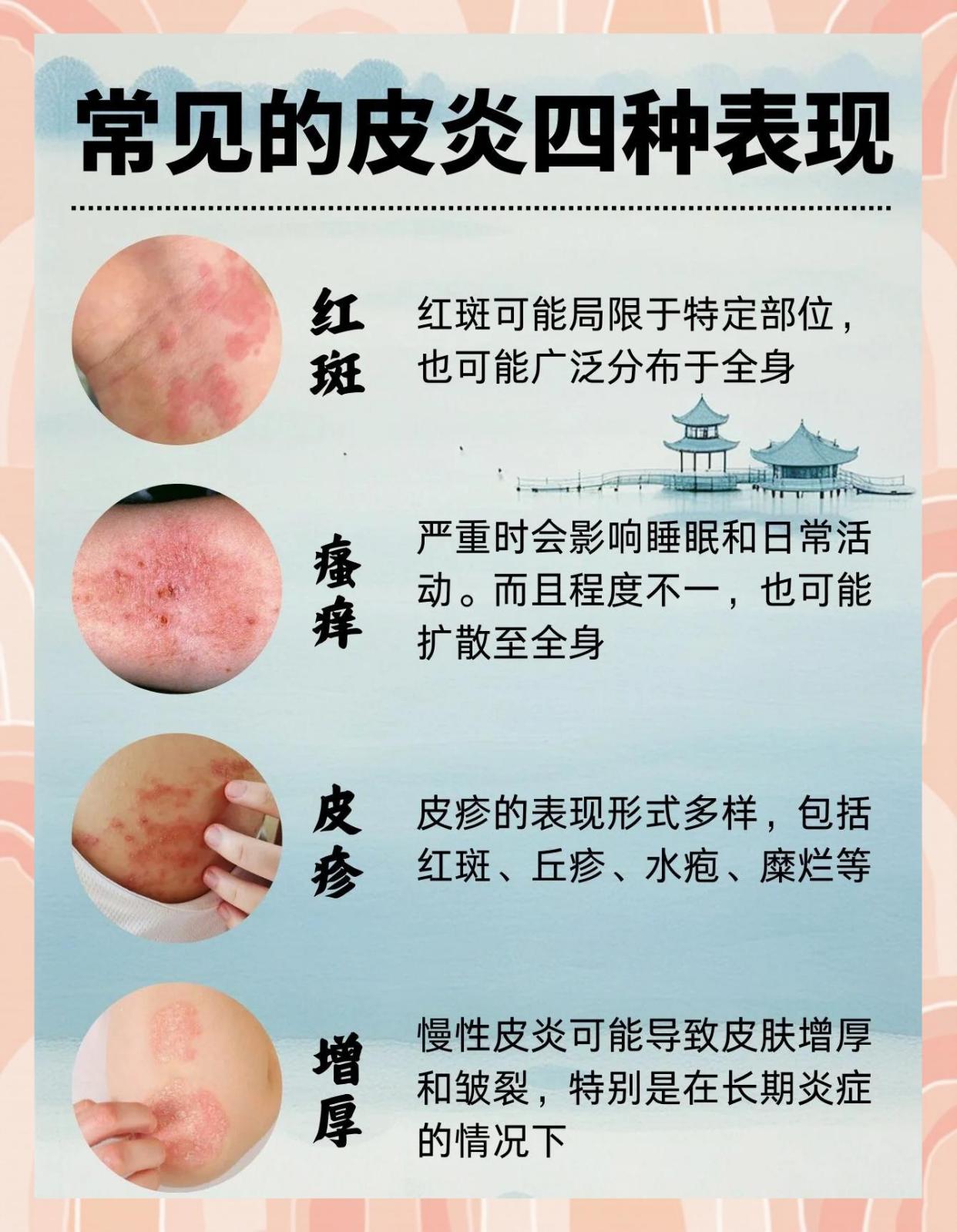 皮炎的四大症状，你中了几个？