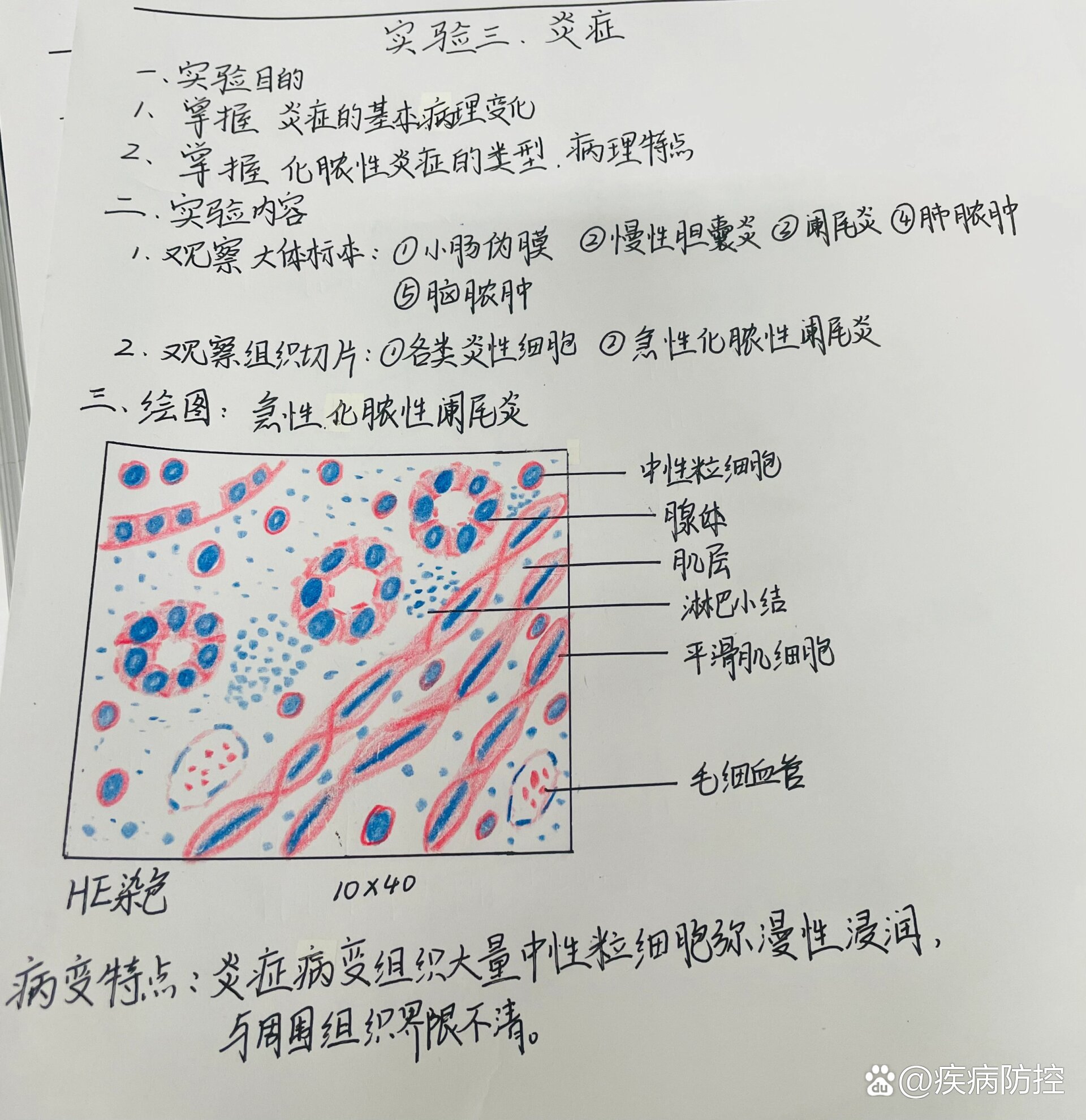 病理实验阑尾炎手绘图图片