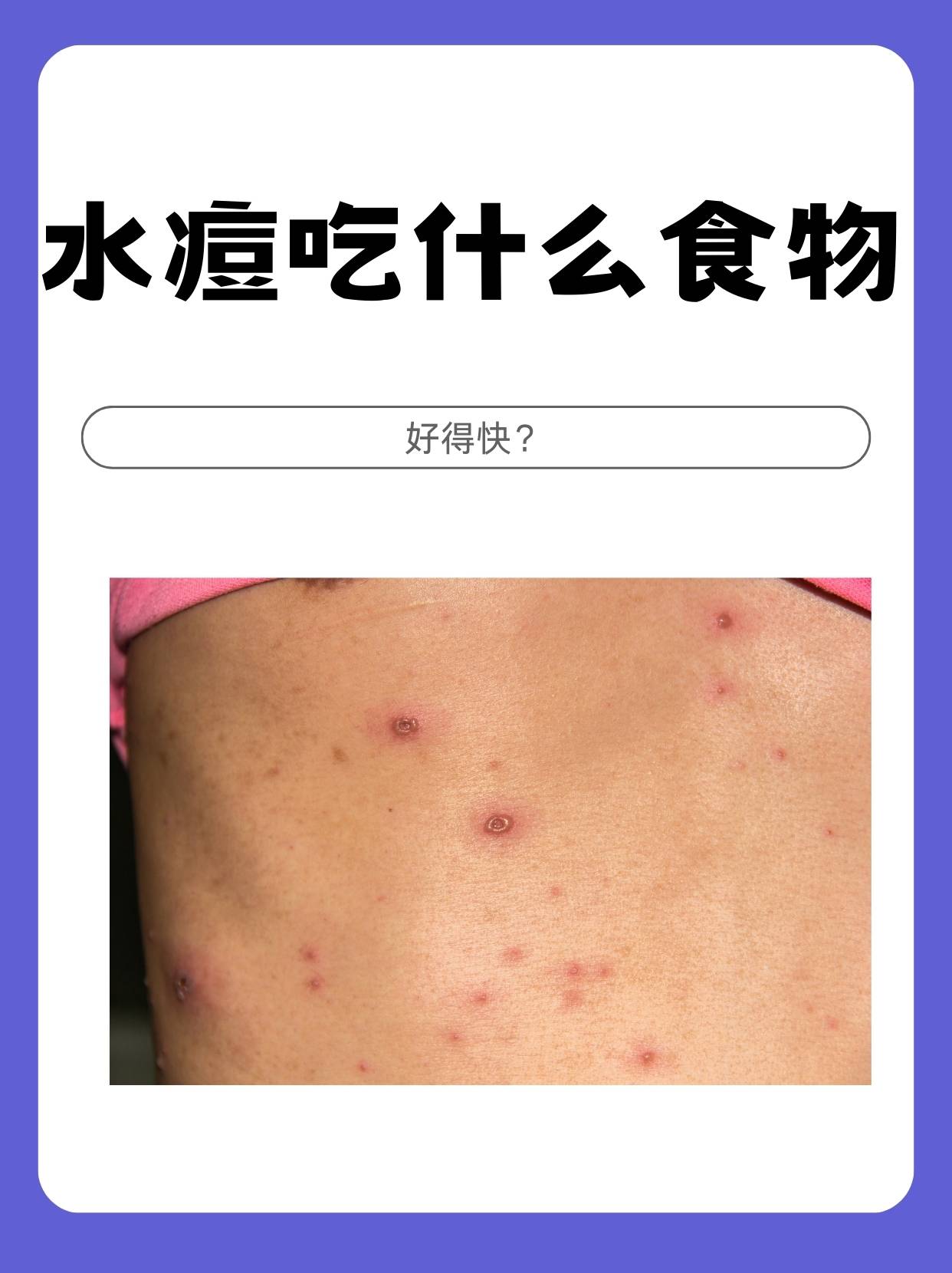 水痘吃什么食物好得快?