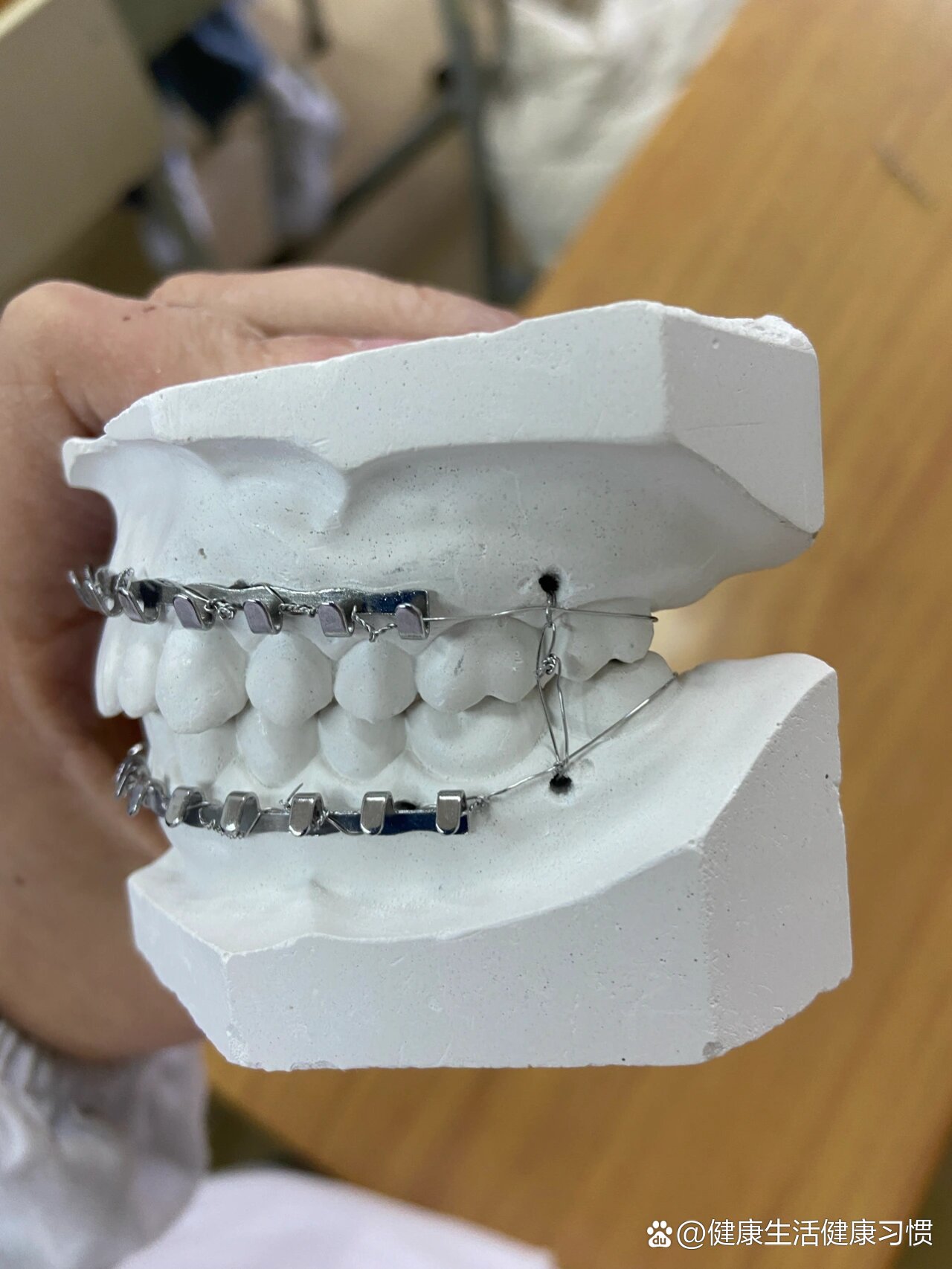 颌骨骨折的牙弓夹板颌间牵引固定