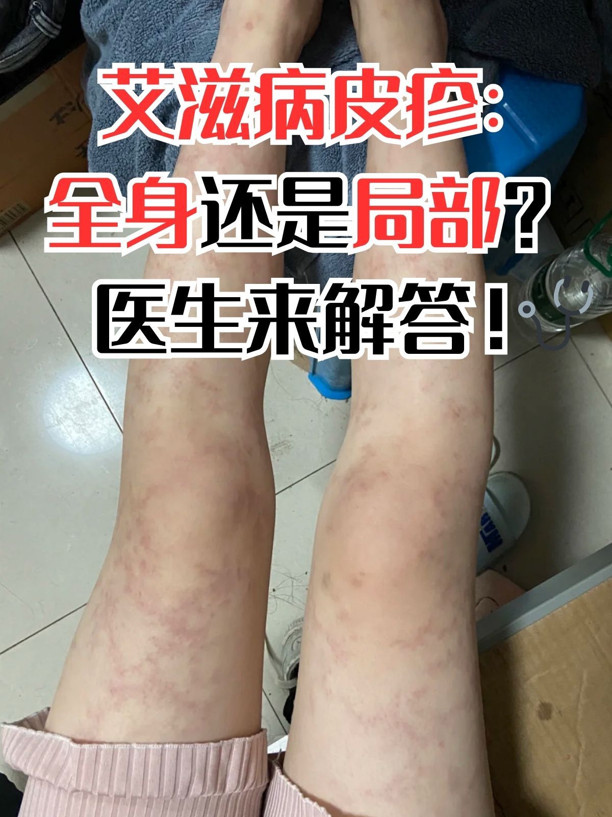 艾滋病皮疹：全身还是局部？