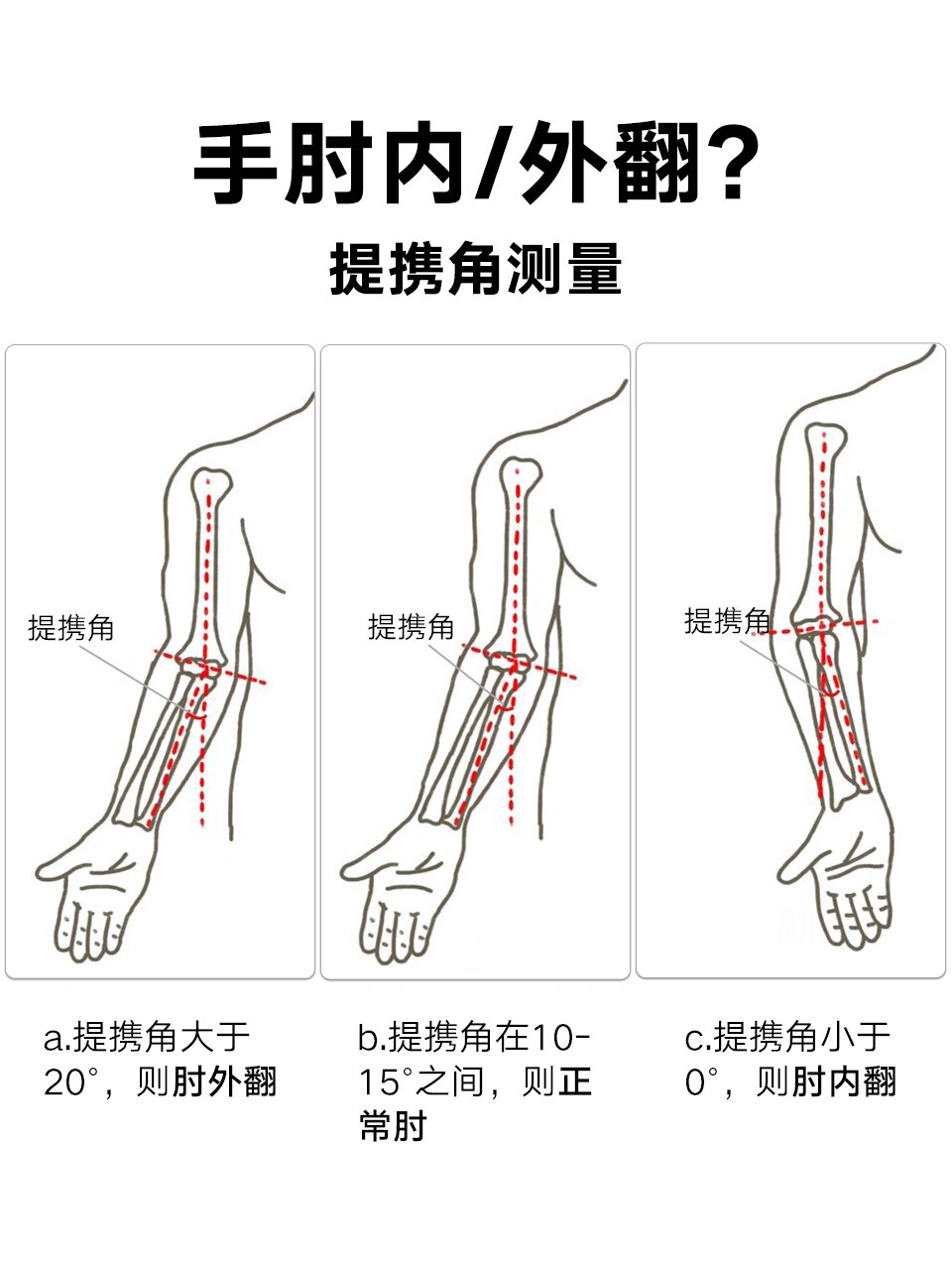 肘外翻有什么影响图片