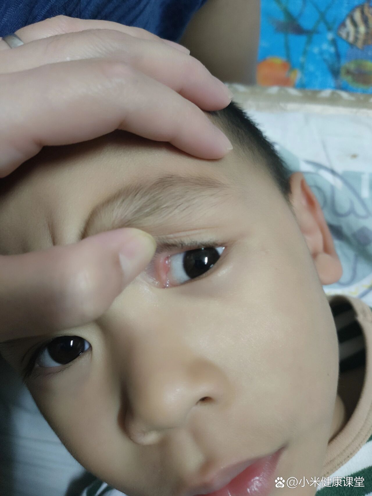 宝宝上眼皮里面长了个疙瘩,不肿不痛是什么