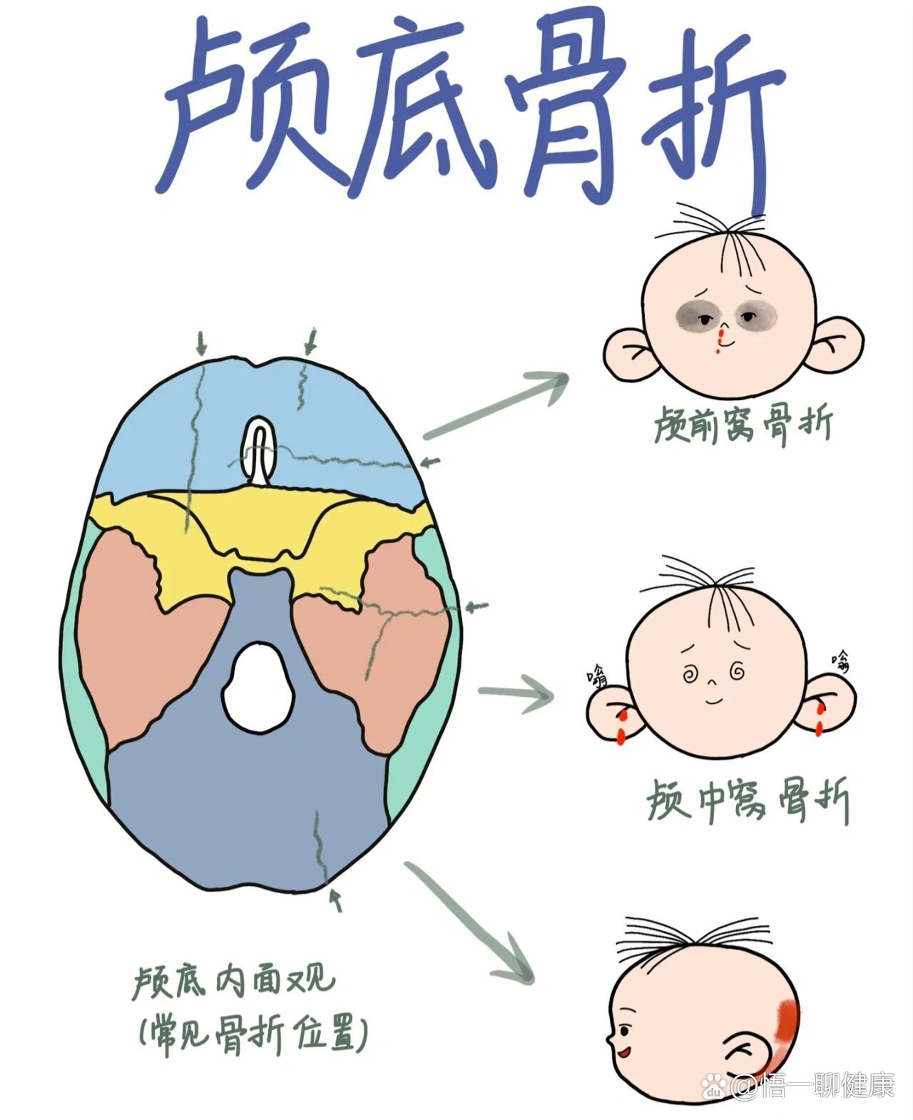 颅骨骨折ppt图片