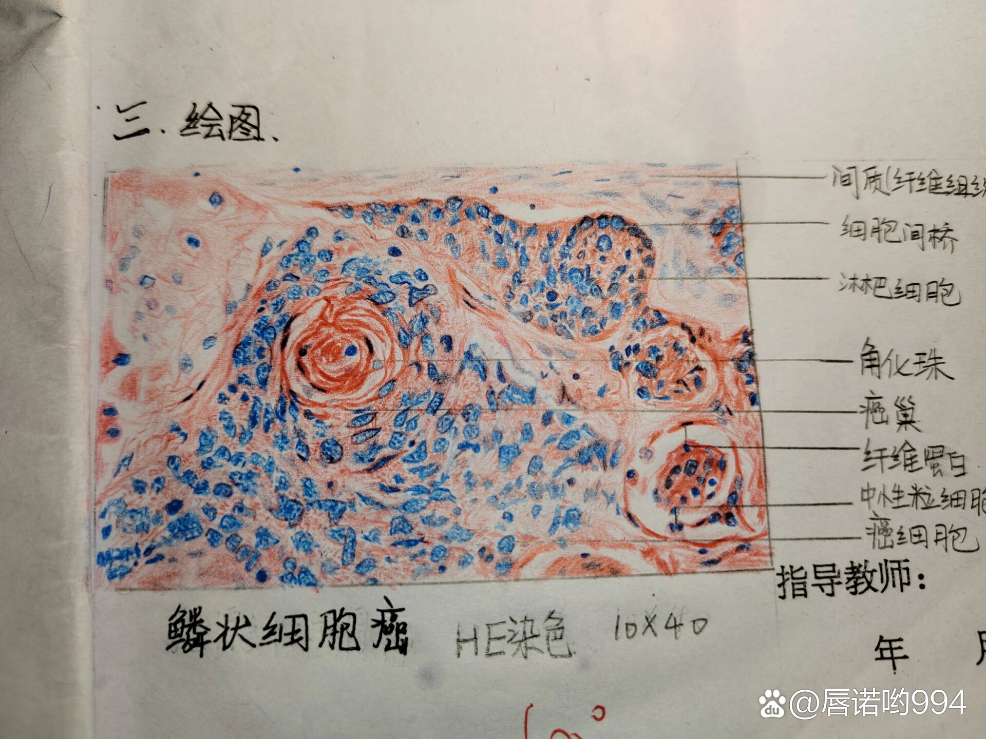 绒癌病理切片手绘图图片