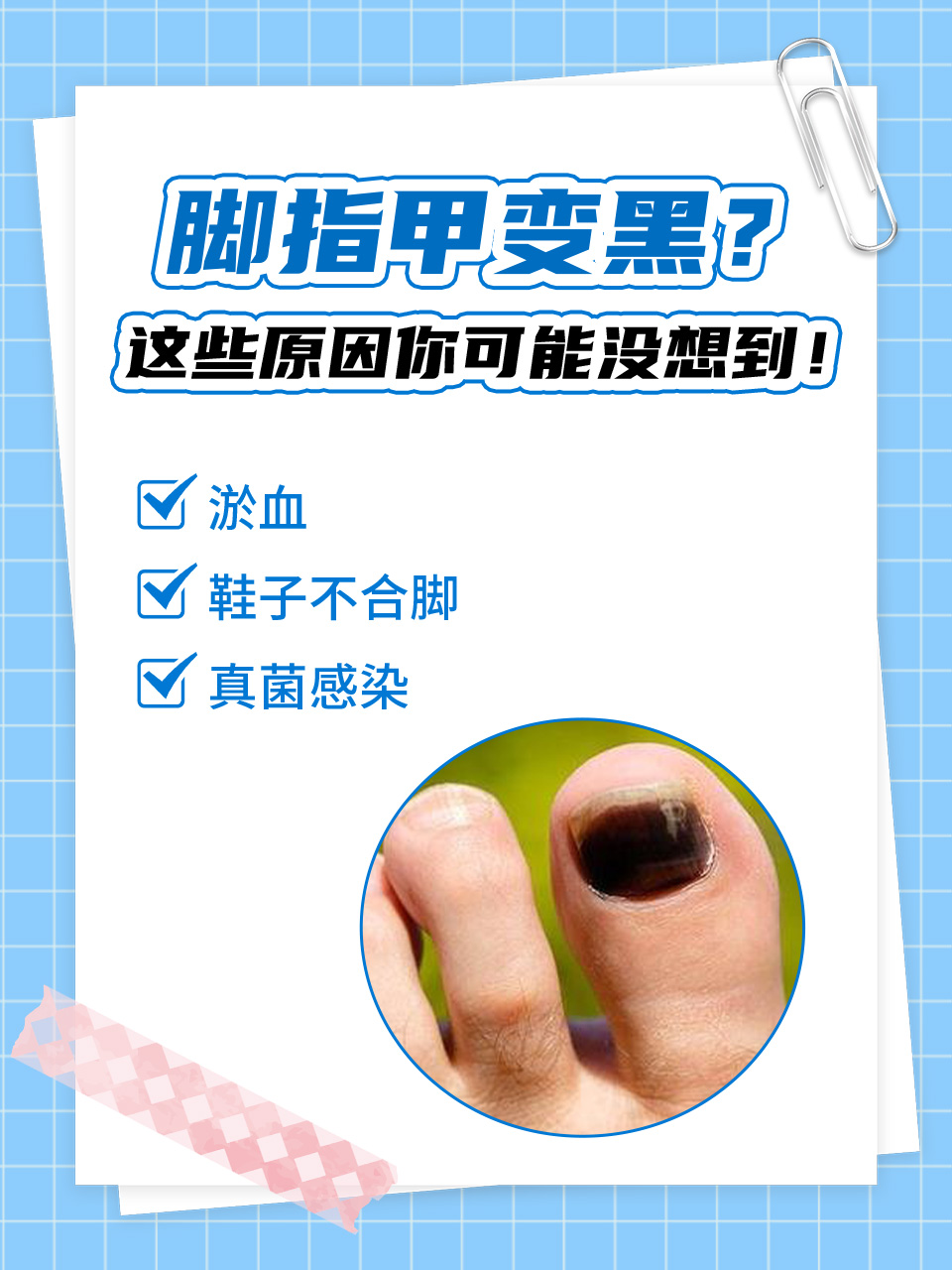 脚指甲变黑?这些原因你可能没想到!