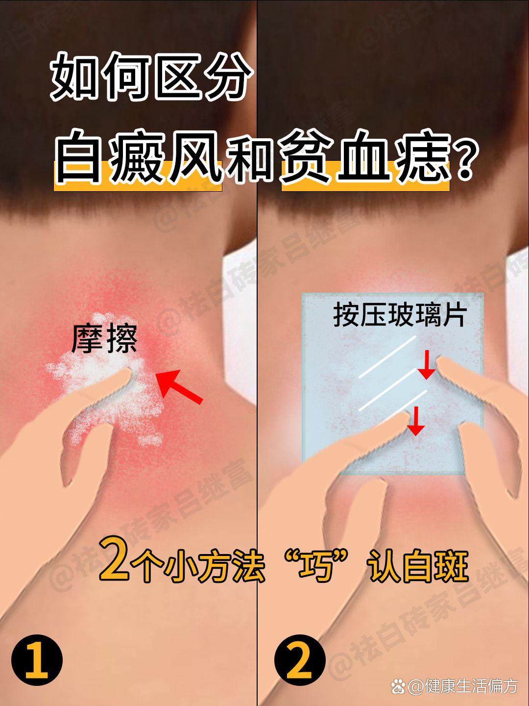  br>贫血痣,主要是由于局部真皮血管先天功能异常,导致持续性收缩