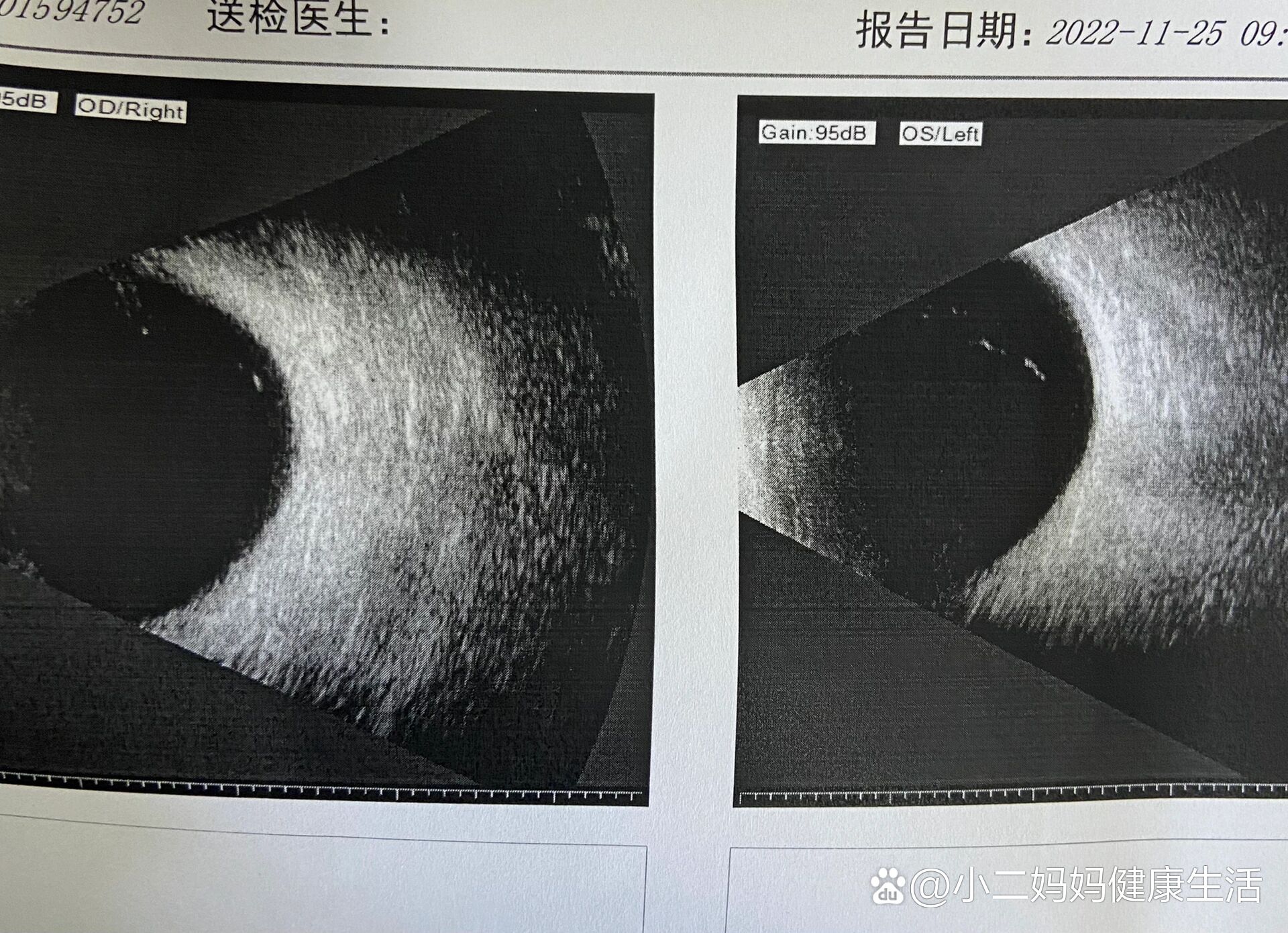 眼睛噪点图片