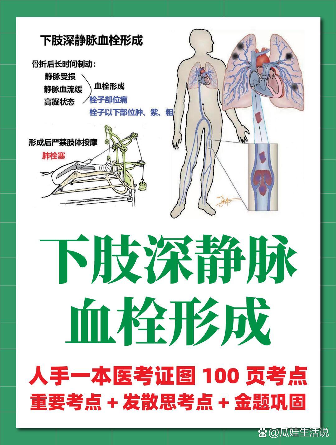 24执医|医学生笔记下肢深静脉血栓形成