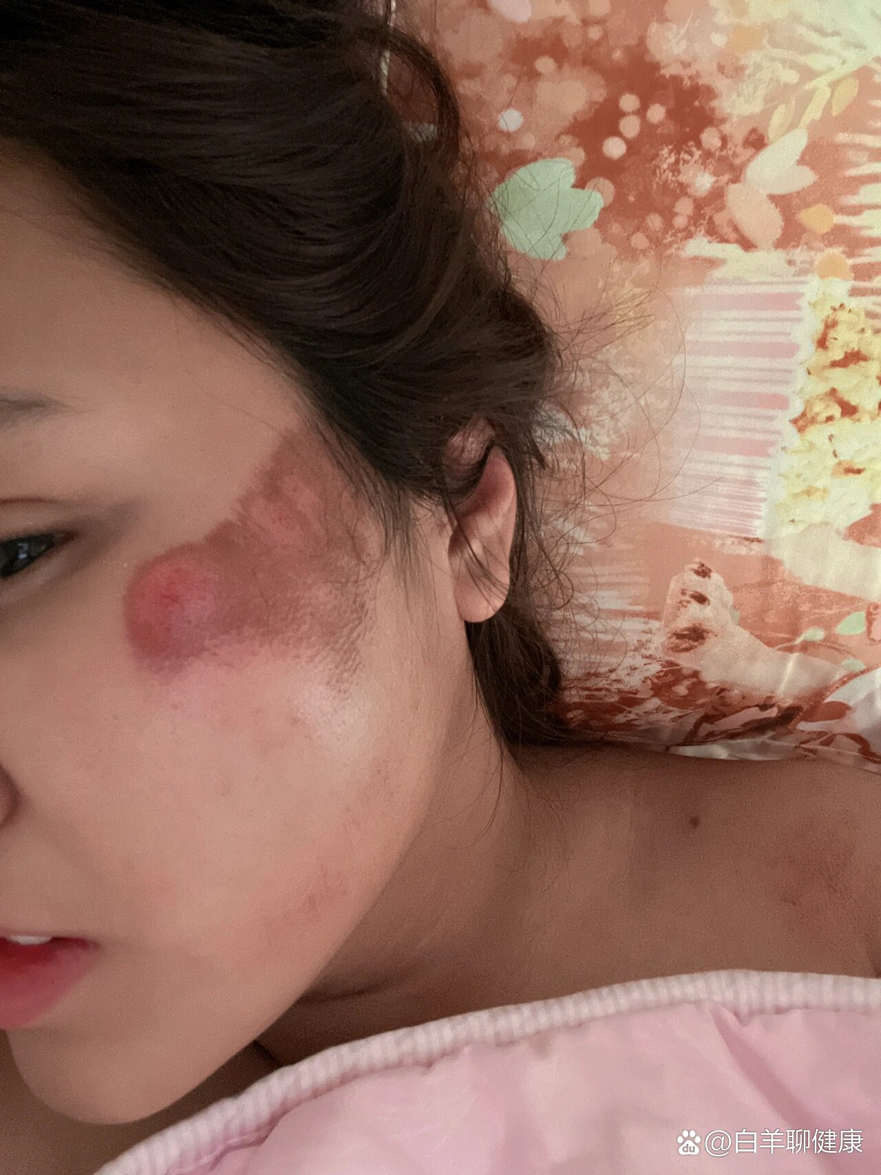 面部擦伤如何恢复