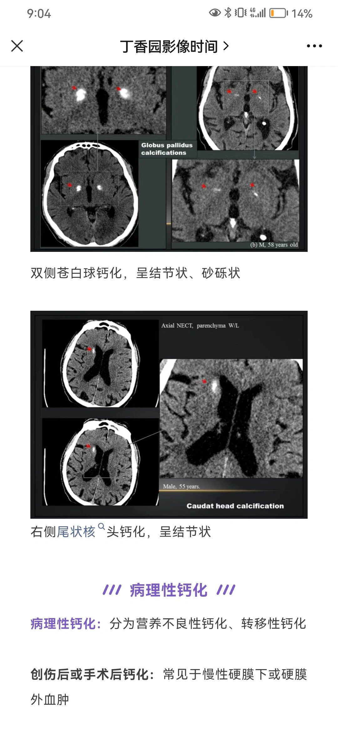 丘脑钙化图片