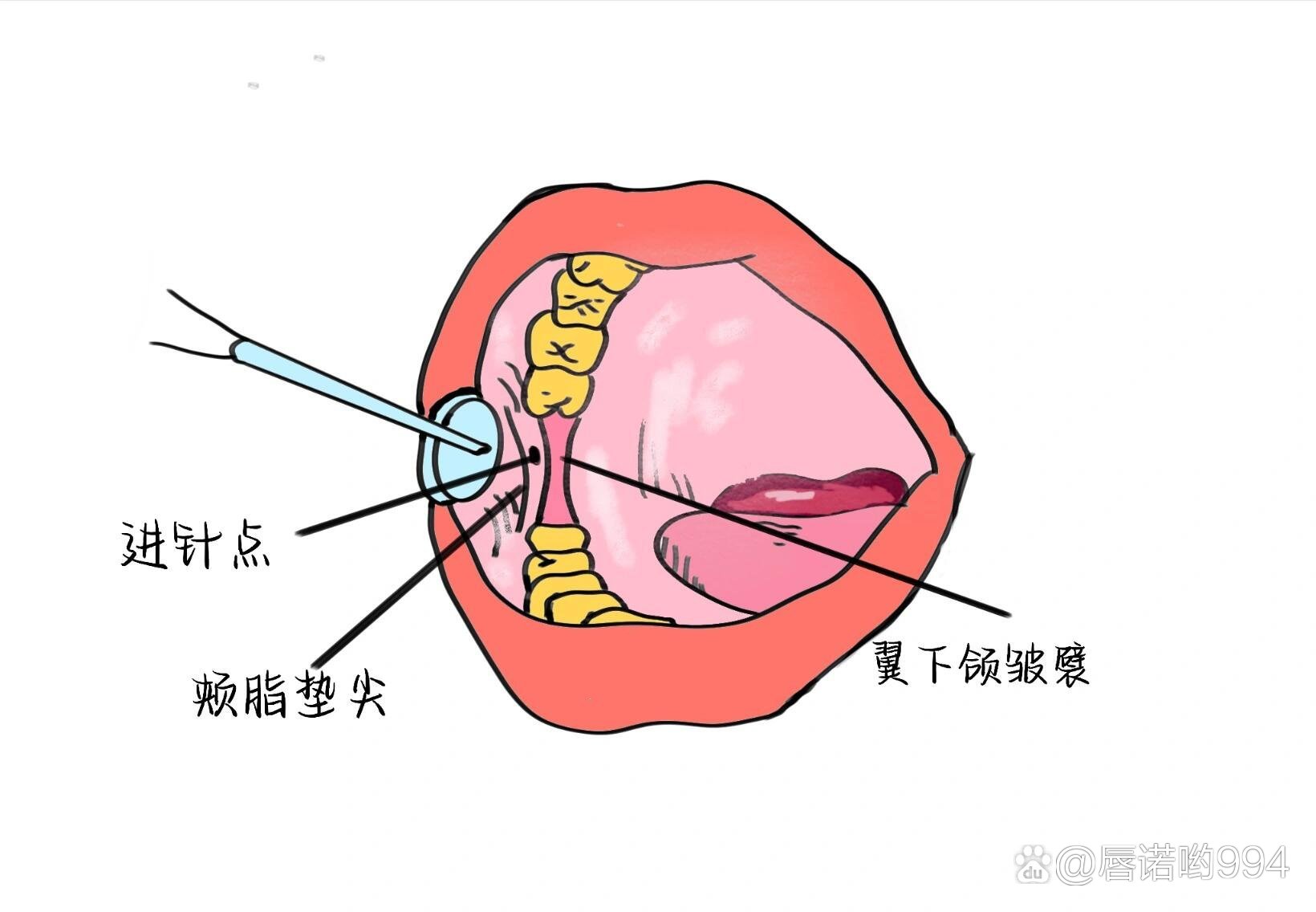 下牙槽神经阻滞麻醉