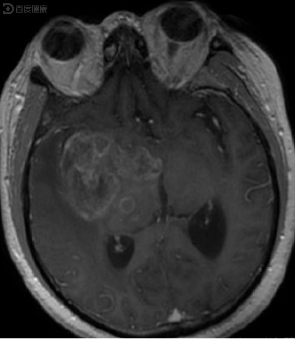及时治疗弥漫性星形细胞瘤,患者康复效果好