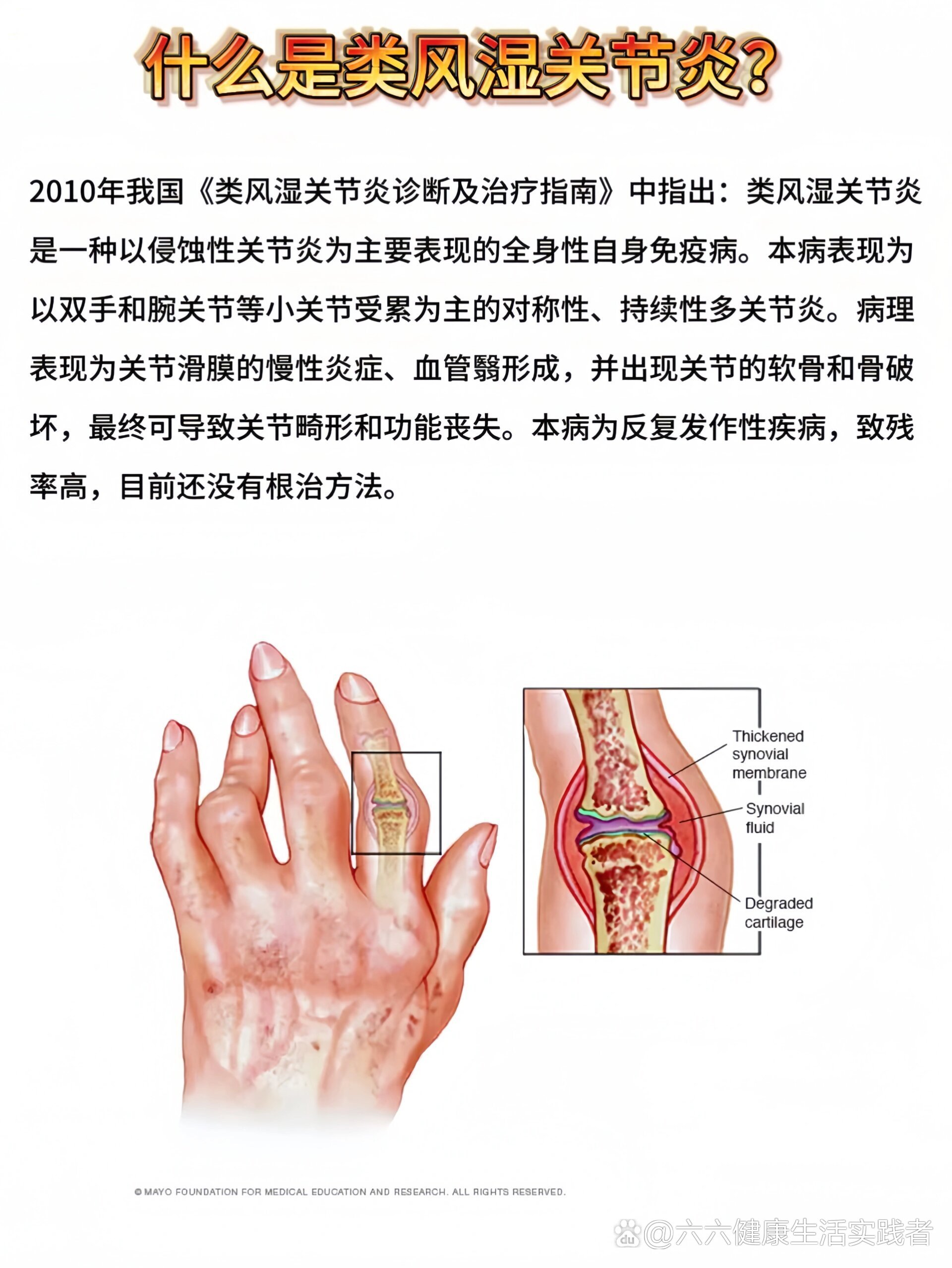 风湿性关节炎图图片