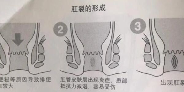 肛裂原因图片