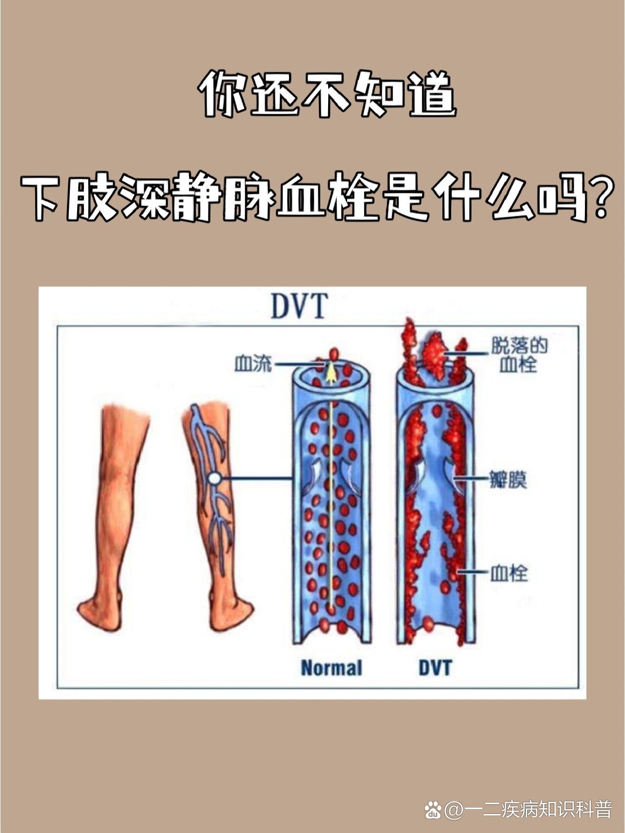 还不知道92下肢深静脉血栓是什么吗02