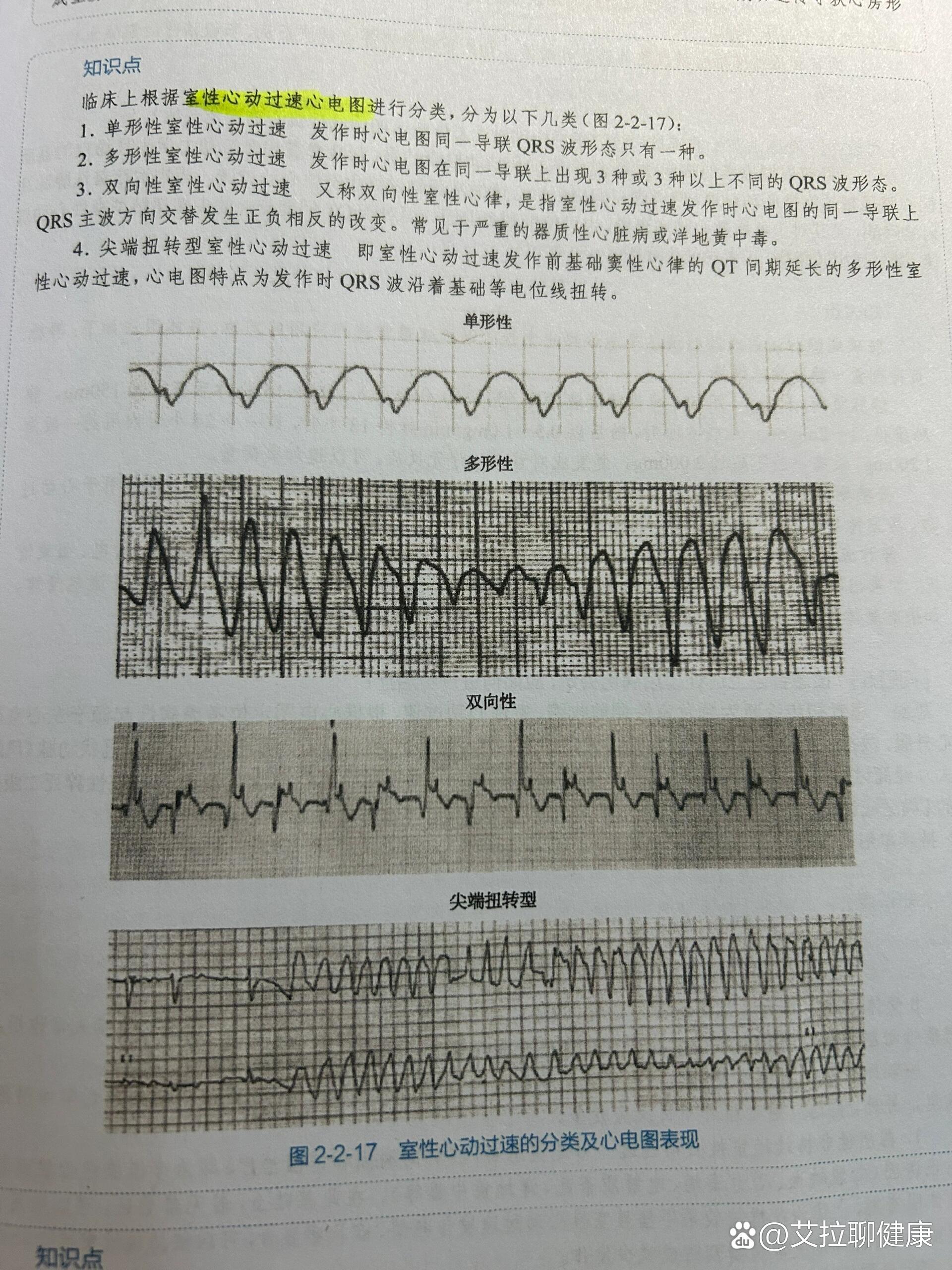 室速心电图类型