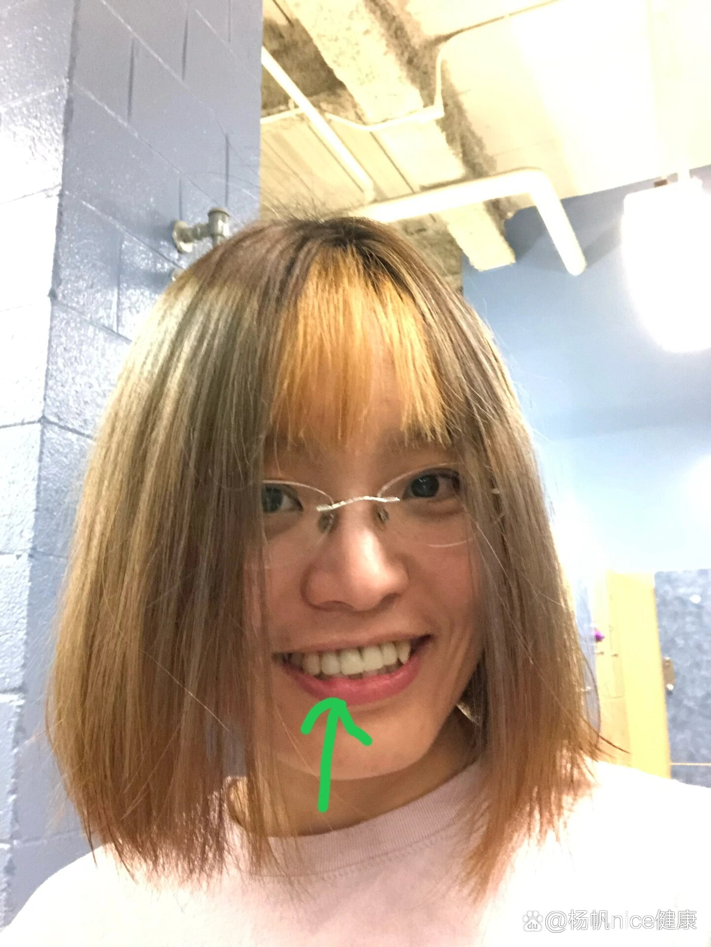 口腔粘液囊肿自愈