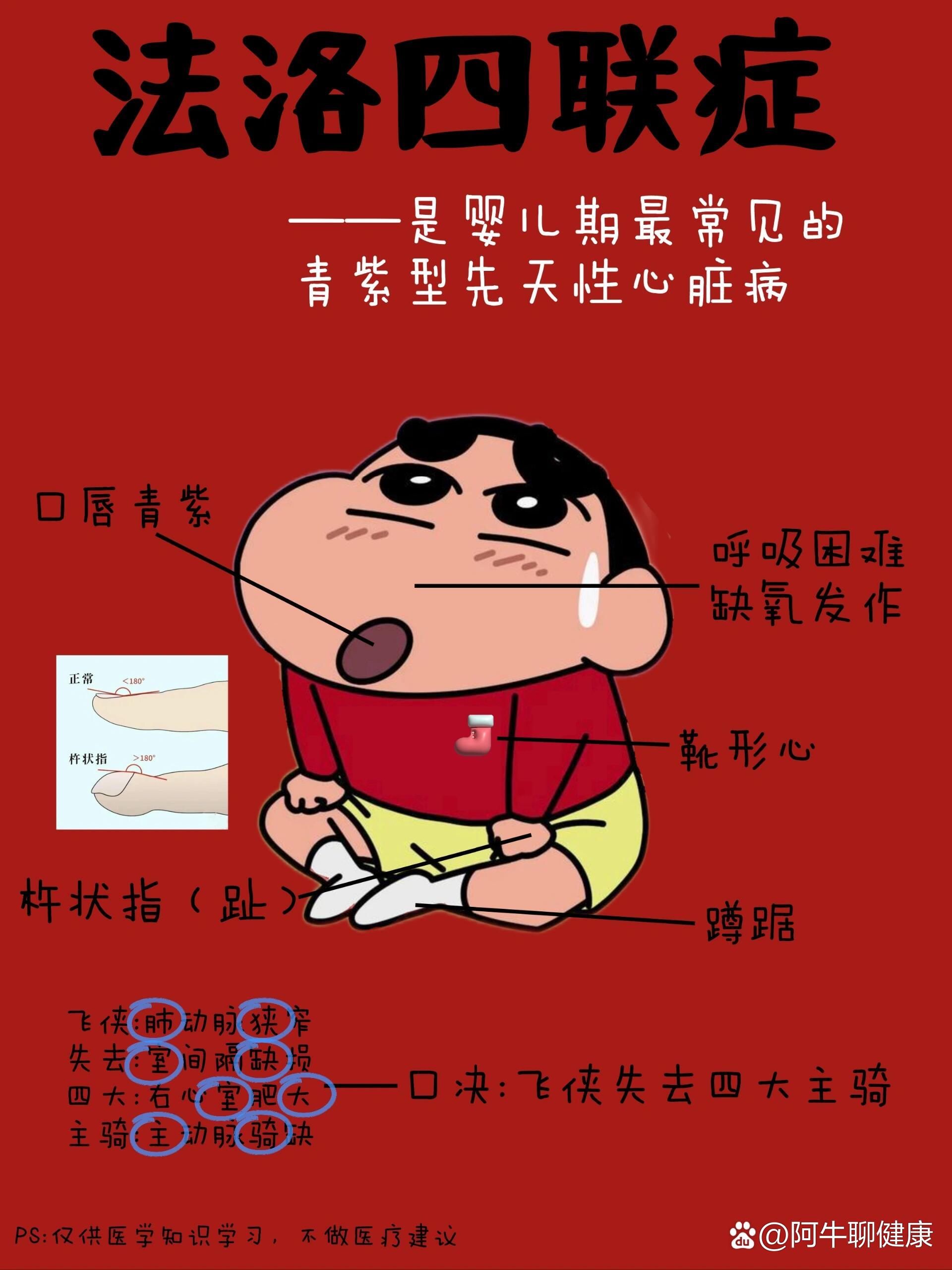 医学生笔记——法洛四联症