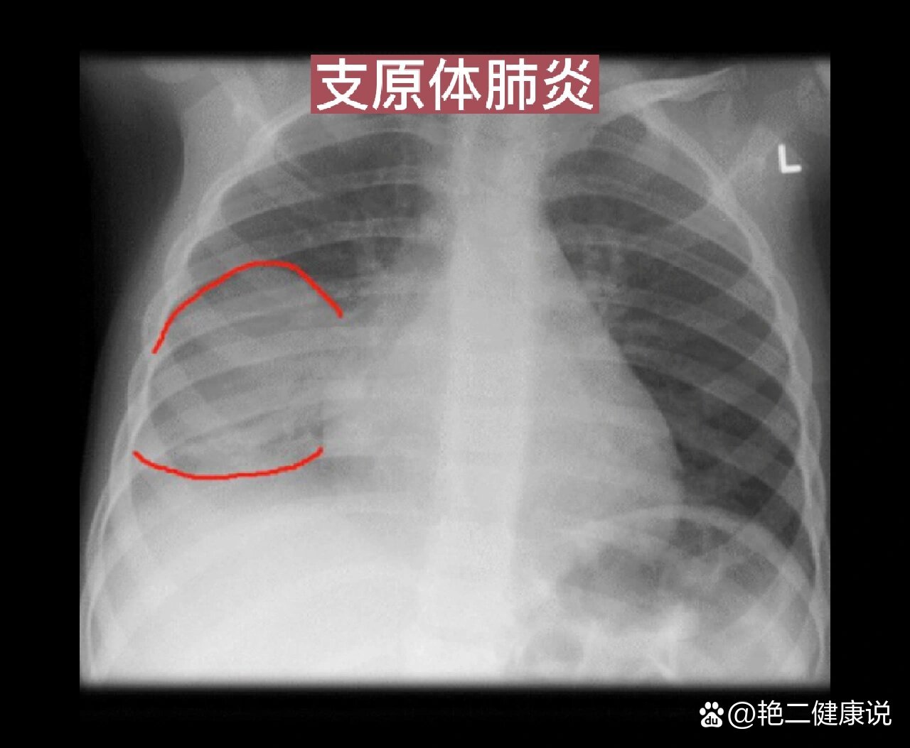 一分钟教你看胸片