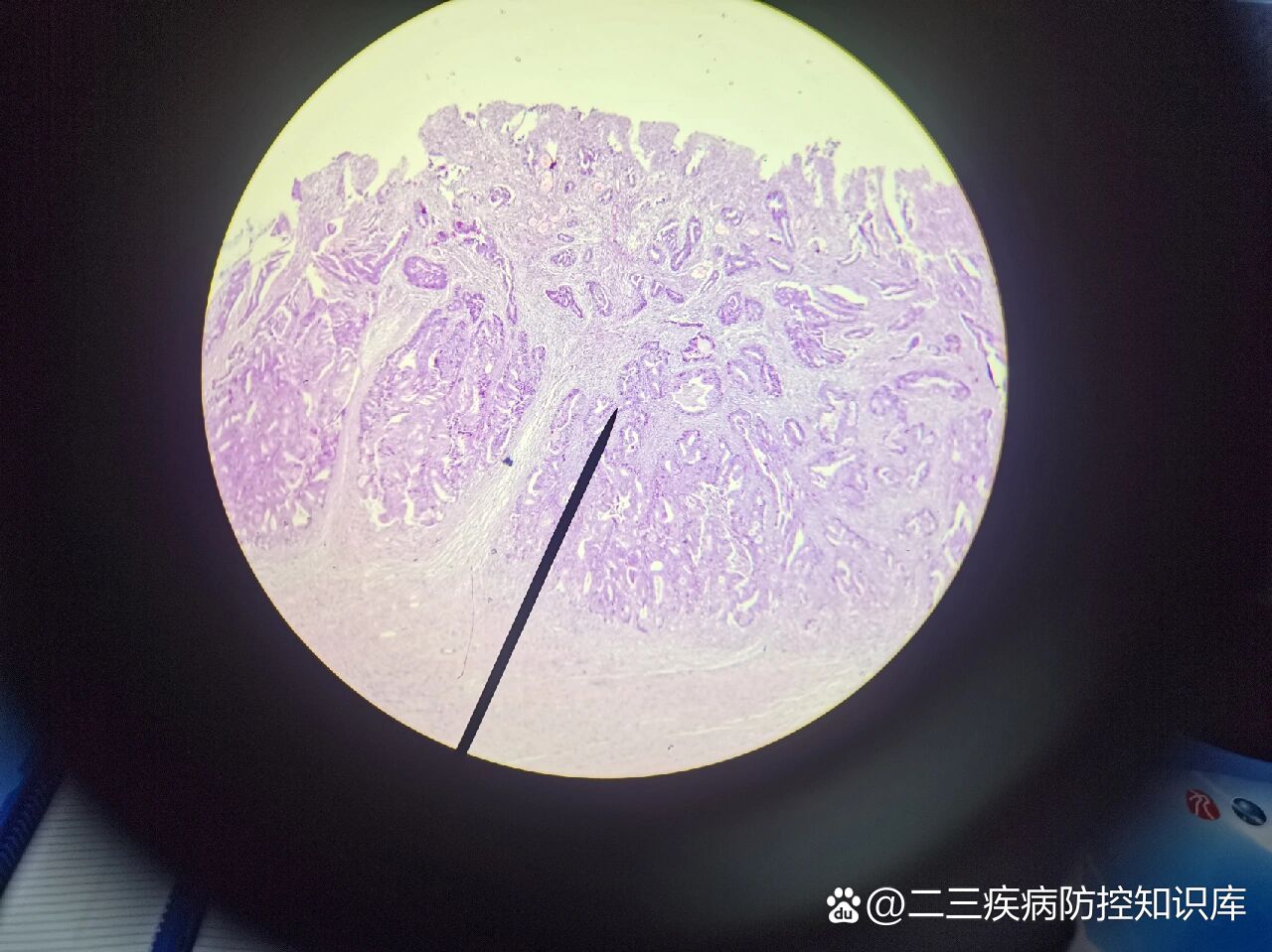  p>病理切片-直肠腺癌 br>诊断描述:低倍镜下,实质与间质分界清晰