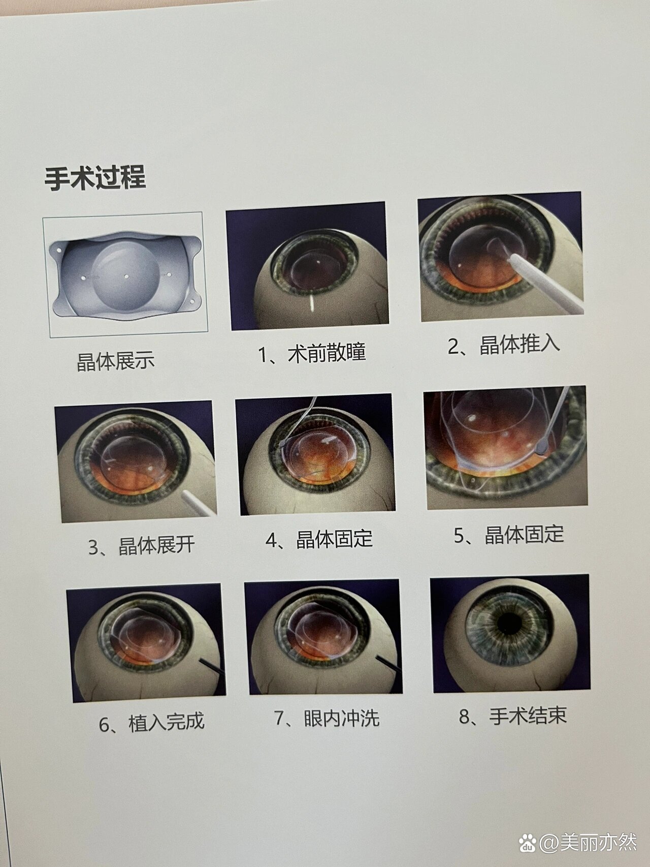 近视眼手术icl晶体植入最全经验分享(下)